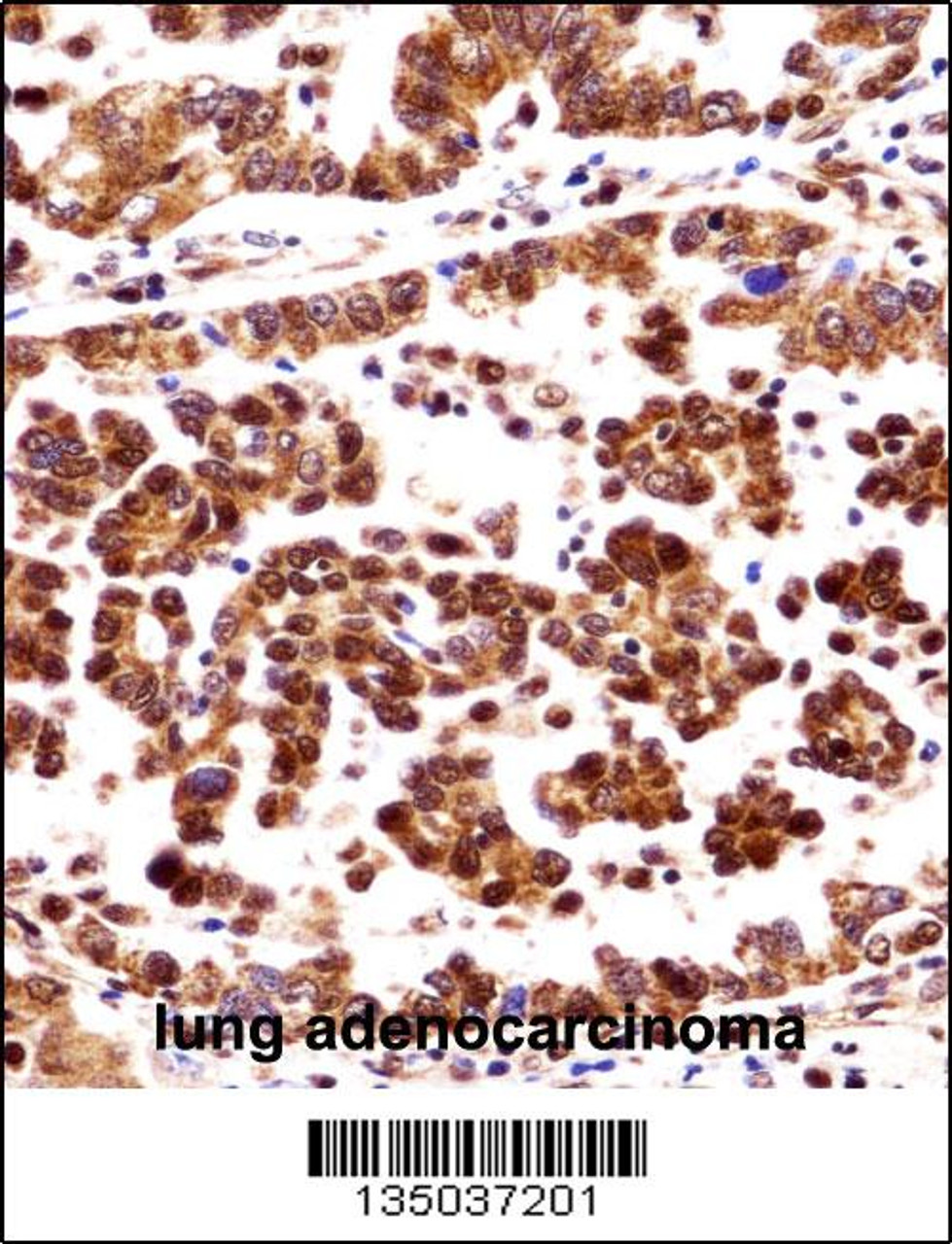 ORC3L Antibody immunohistochemistry analysis in formalin fixed and paraffin embedded human lung adenocarcinoma followed by peroxidase conjugation of the secondary antibody and DAB staining.