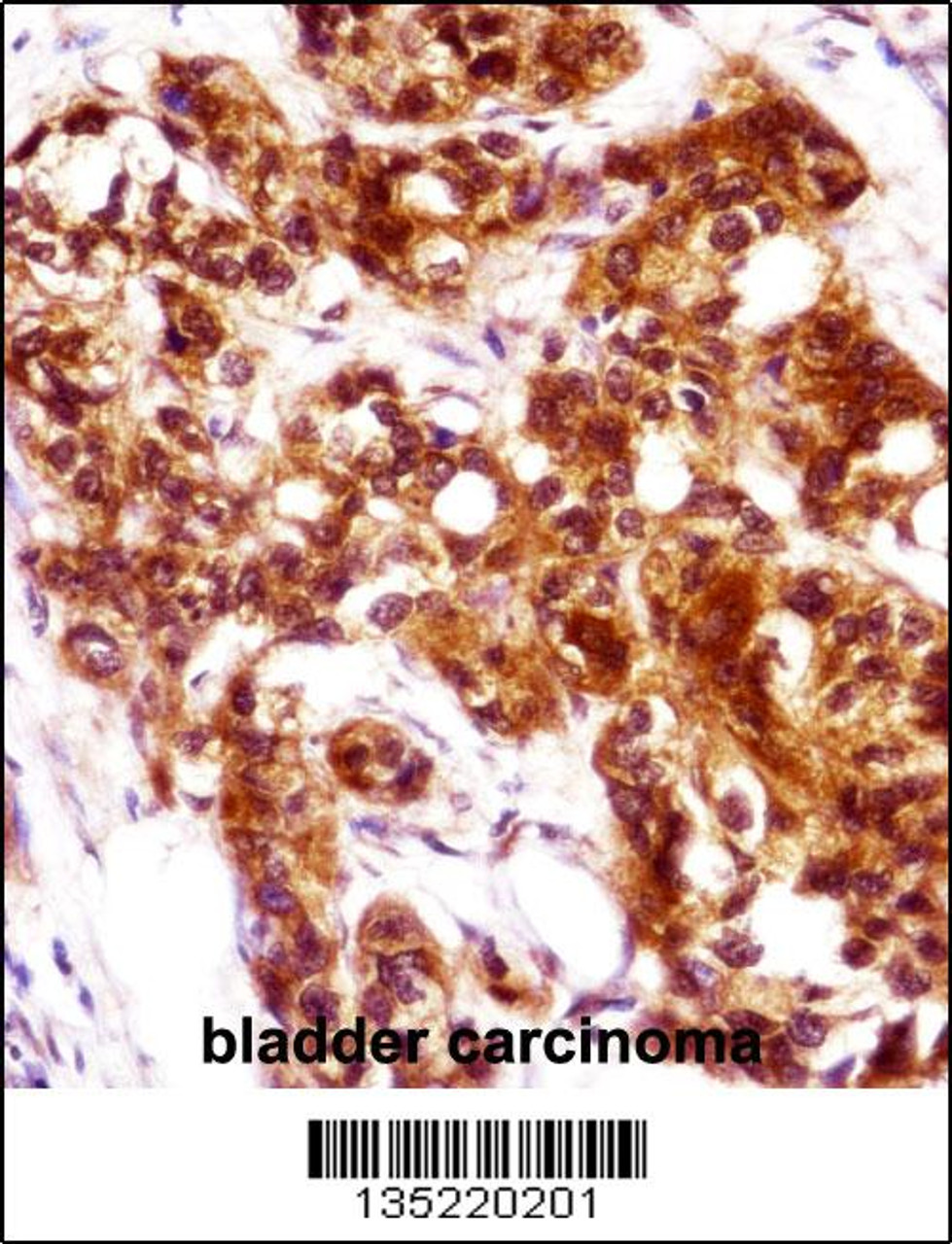KRT7 Antibody immunohistochemistry analysis in formalin fixed and paraffin embedded human bladder carcinoma followed by peroxidase conjugation of the secondary antibody and DAB staining.