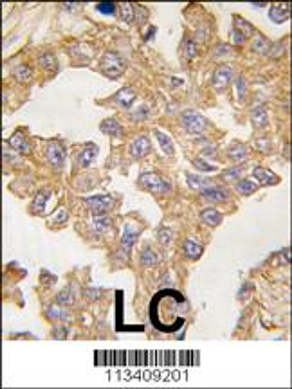 Formalin-fixed and paraffin-embedded human lung carcinoma tissue reacted with ACTB/ACTC antibody, which was peroxidase-conjugated to the secondary antibody, followed by DAB staining.