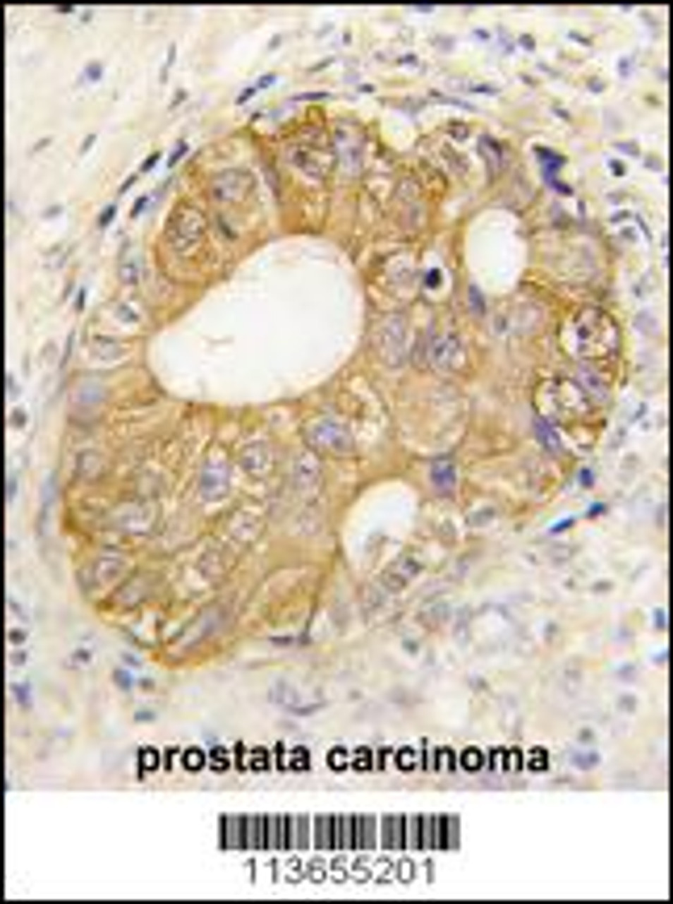 Formalin-fixed and paraffin-embedded human prostata carcinoma tissue reacted with CDH3 antibody, which was peroxidase-conjugated to the secondary antibody, followed by DAB staining.