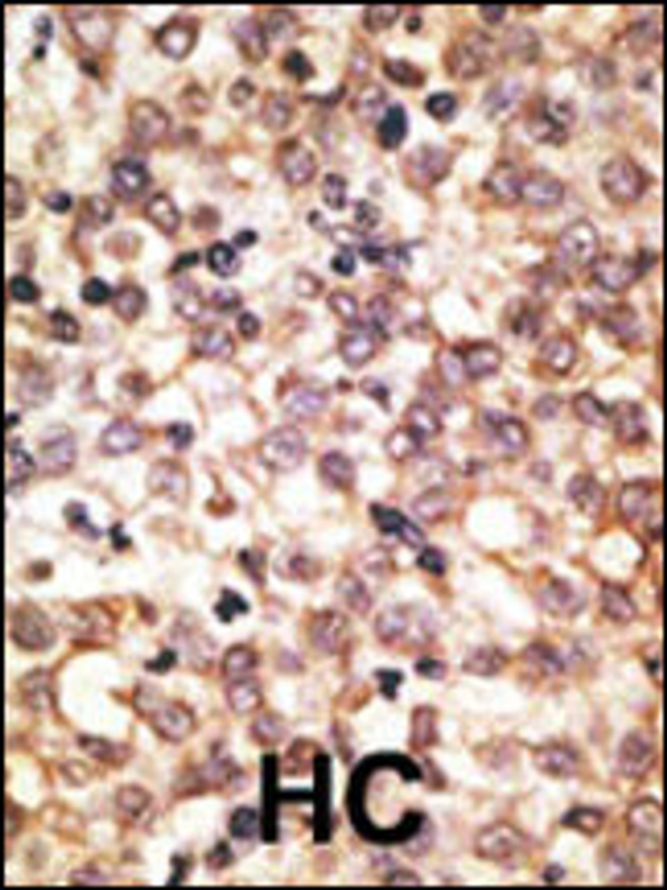 Formalin-fixed and paraffin-embedded human cancer tissue reacted with the primary antibody, which was peroxidase-conjugated to the secondary antibody, followed by AEC staining. BC = breast carcinoma; HC = hepatocarcinoma.