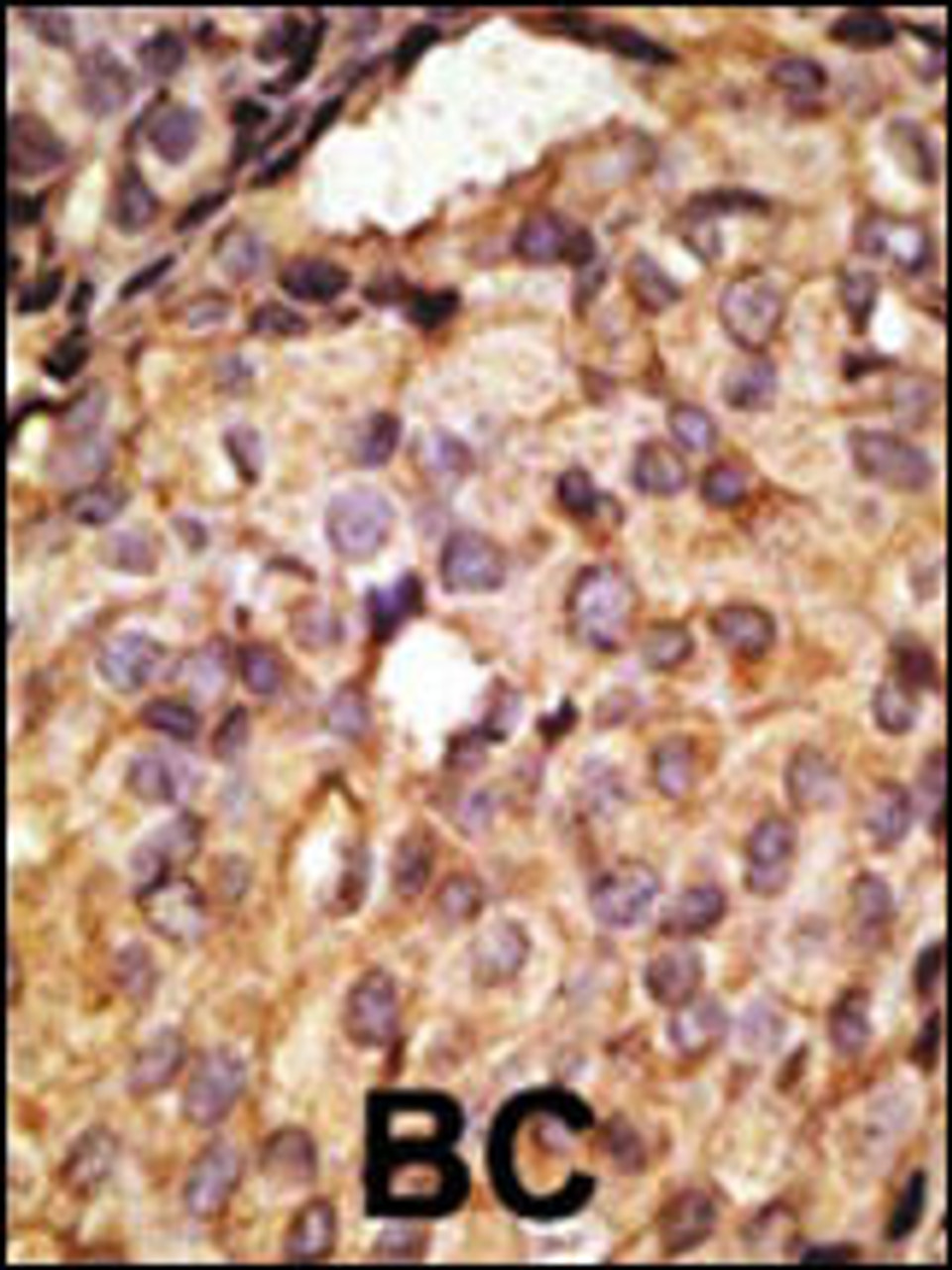 Formalin-fixed and paraffin-embedded human cancer tissue reacted with the primary antibody, which was peroxidase-conjugated to the secondary antibody, followed by AEC staining. BC = breast carcinoma; HC = hepatocarcinoma.