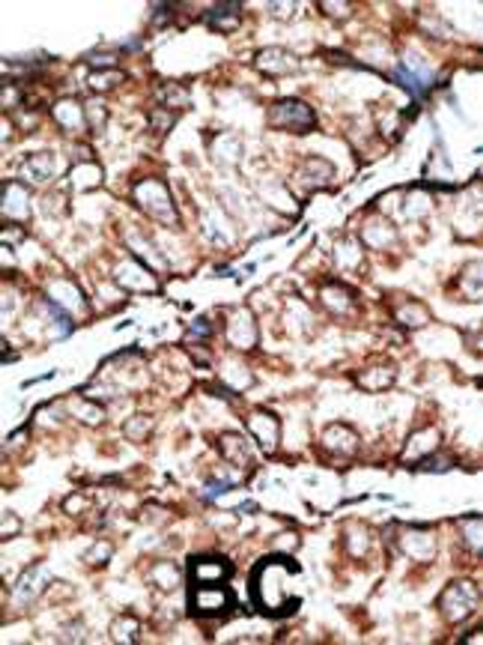 Formalin-fixed and paraffin-embedded human cancer tissue reacted with the primary antibody, which was peroxidase-conjugated to the secondary antibody, followed by DAB staining. BC = breast carcinoma; HC = hepatocarcinoma.