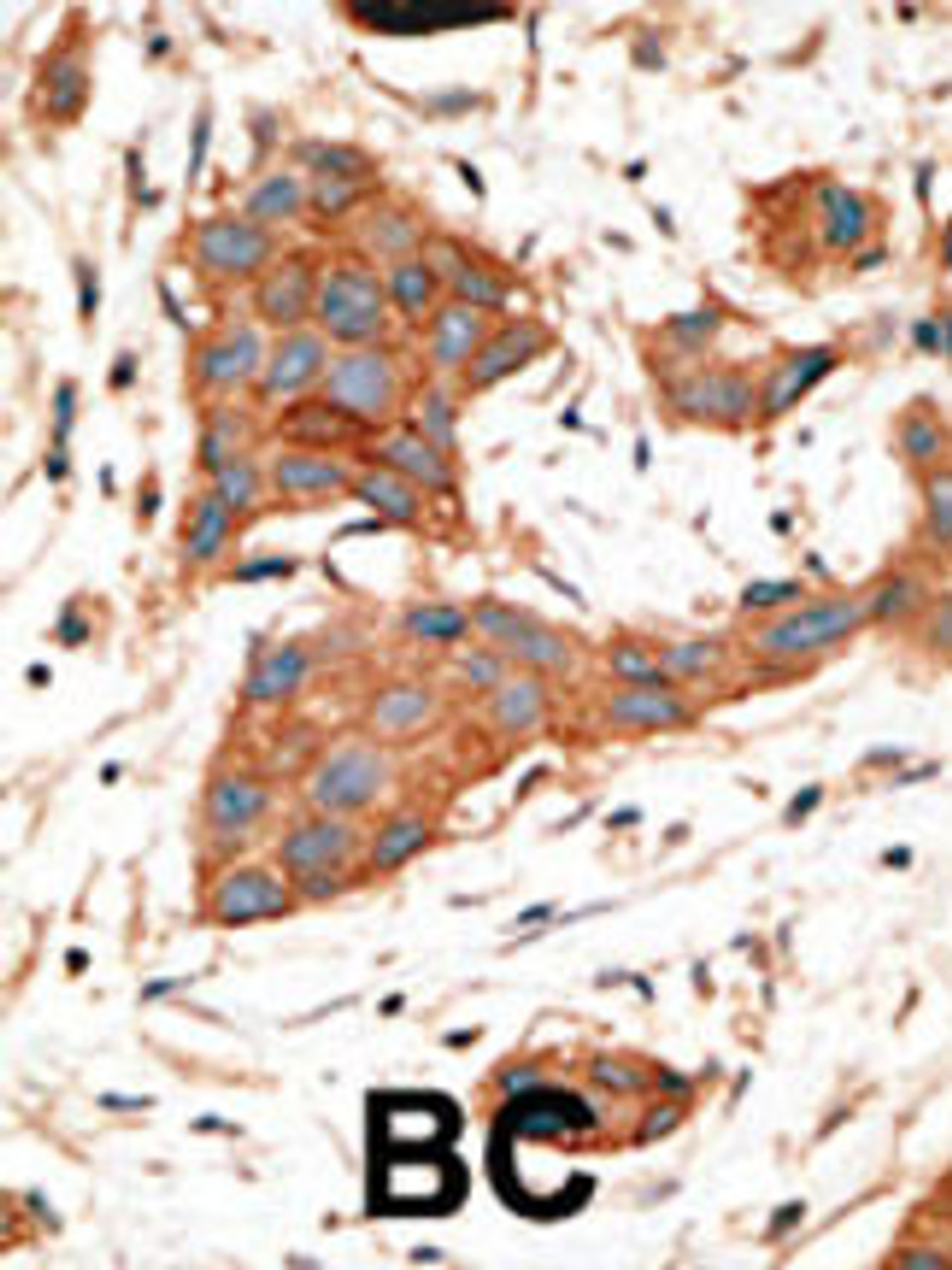 Formalin-fixed and paraffin-embedded human cancer tissue reacted with the primary antibody, which was peroxidase-conjugated to the secondary antibody, followed by DAB staining. BC = breast carcinoma;