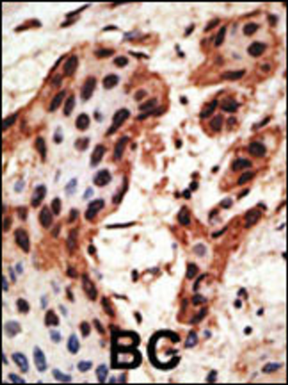 Formalin-fixed and paraffin-embedded human cancer tissue reacted with the primary antibody, which was peroxidase-conjugated to the secondary antibody, followed by AEC staining. BC = breast carcinoma; HC = hepatocarcinoma.