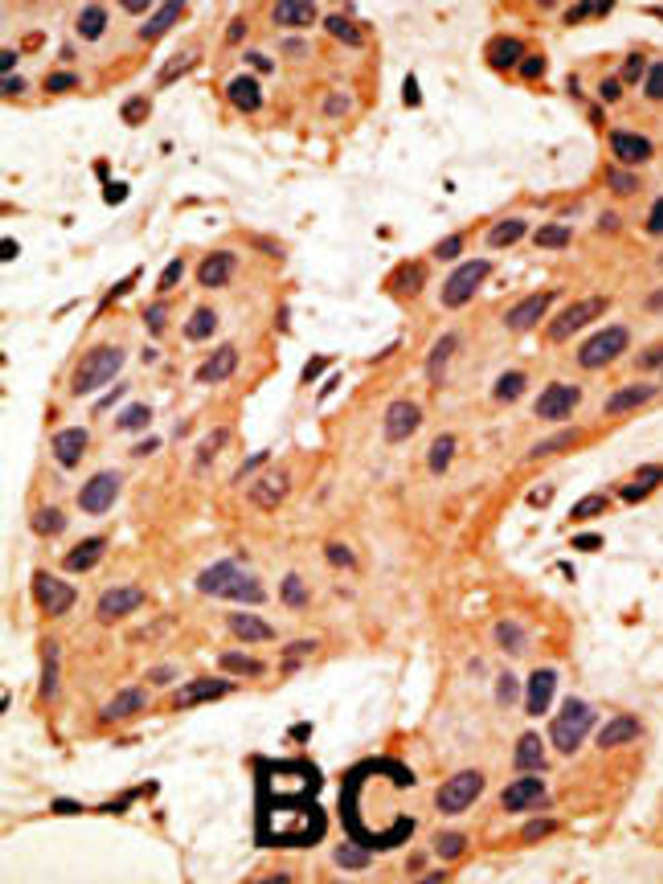 Formalin-fixed and paraffin-embedded human cancer tissue reacted with the primary antibody, which was peroxidase-conjugated to the secondary antibody, followed by DAB staining. BC = breast carcinoma; HC = hepatocarcinoma.