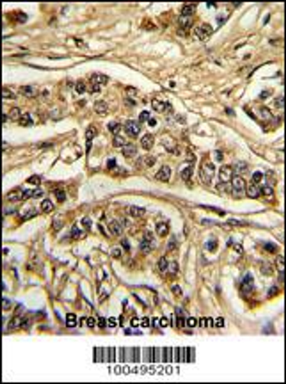 Formalin-fixed and paraffin-embedded human breast carcinoma reacted with NCS1 Antibody, which was peroxidase-conjugated to the secondary antibody, followed by DAB staining.