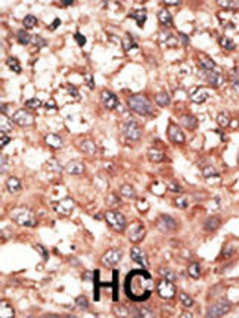 Formalin-fixed and paraffin-embedded human cancer tissue reacted with the primary antibody, which was peroxidase-conjugated to the secondary antibody, followed by AEC staining. BC = breast carcinoma; HC = hepatocarcinoma.