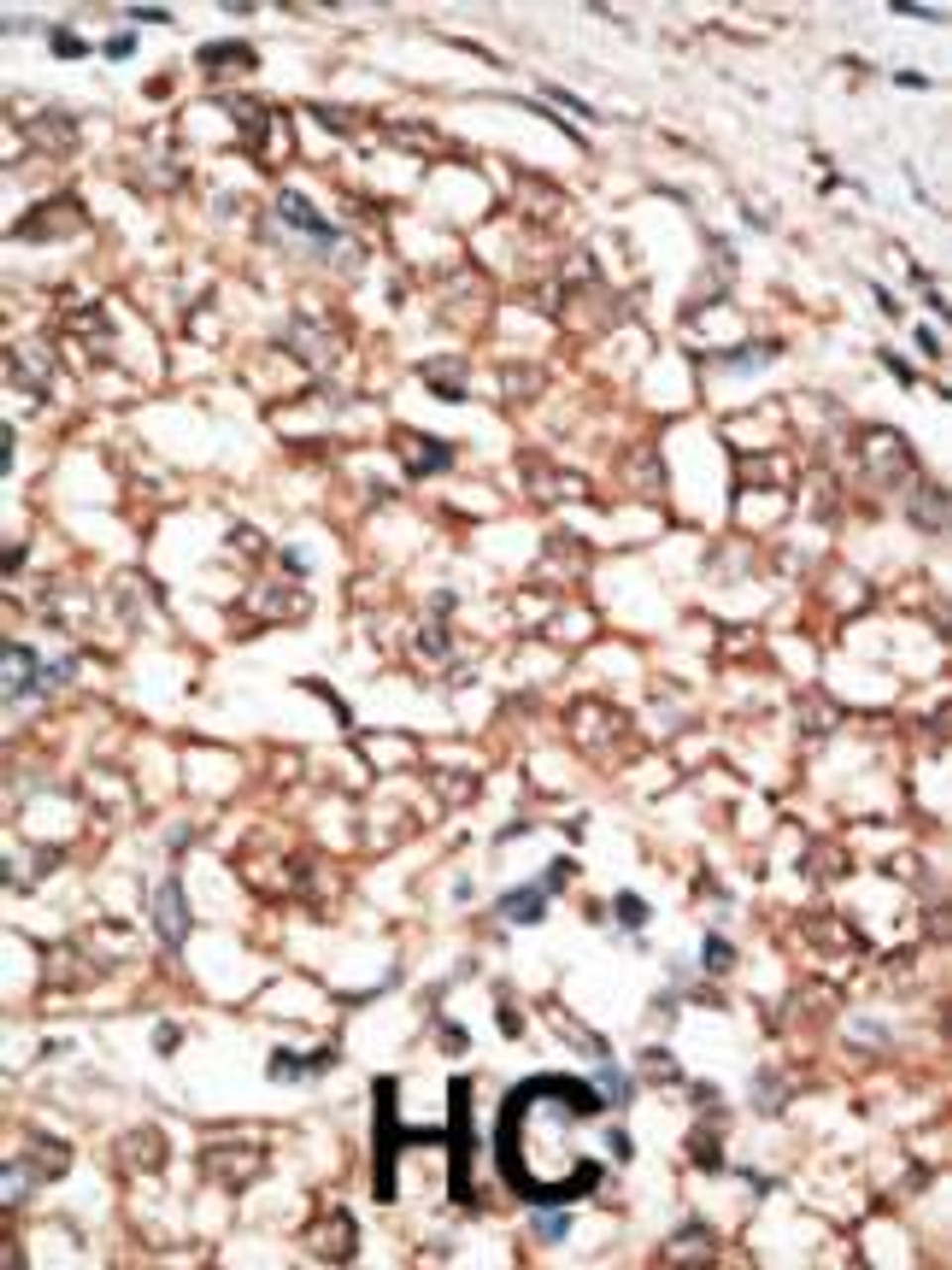 Formalin-fixed and paraffin-embedded human cancer tissue reacted with the primary antibody, which was peroxidase-conjugated to the secondary antibody, followed by DAB staining. BC = breast carcinoma; HC = hepatocarcinoma.