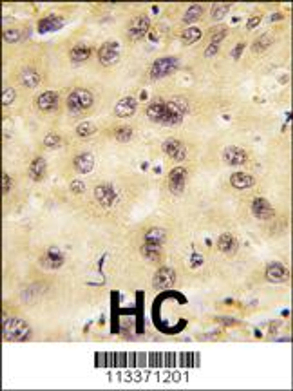 Formalin-fixed and paraffin-embedded human hepatocarcinoma tissue reacted with PROX1 antibody, which was peroxidase-conjugated to the secondary antibody, followed by DAB staining.