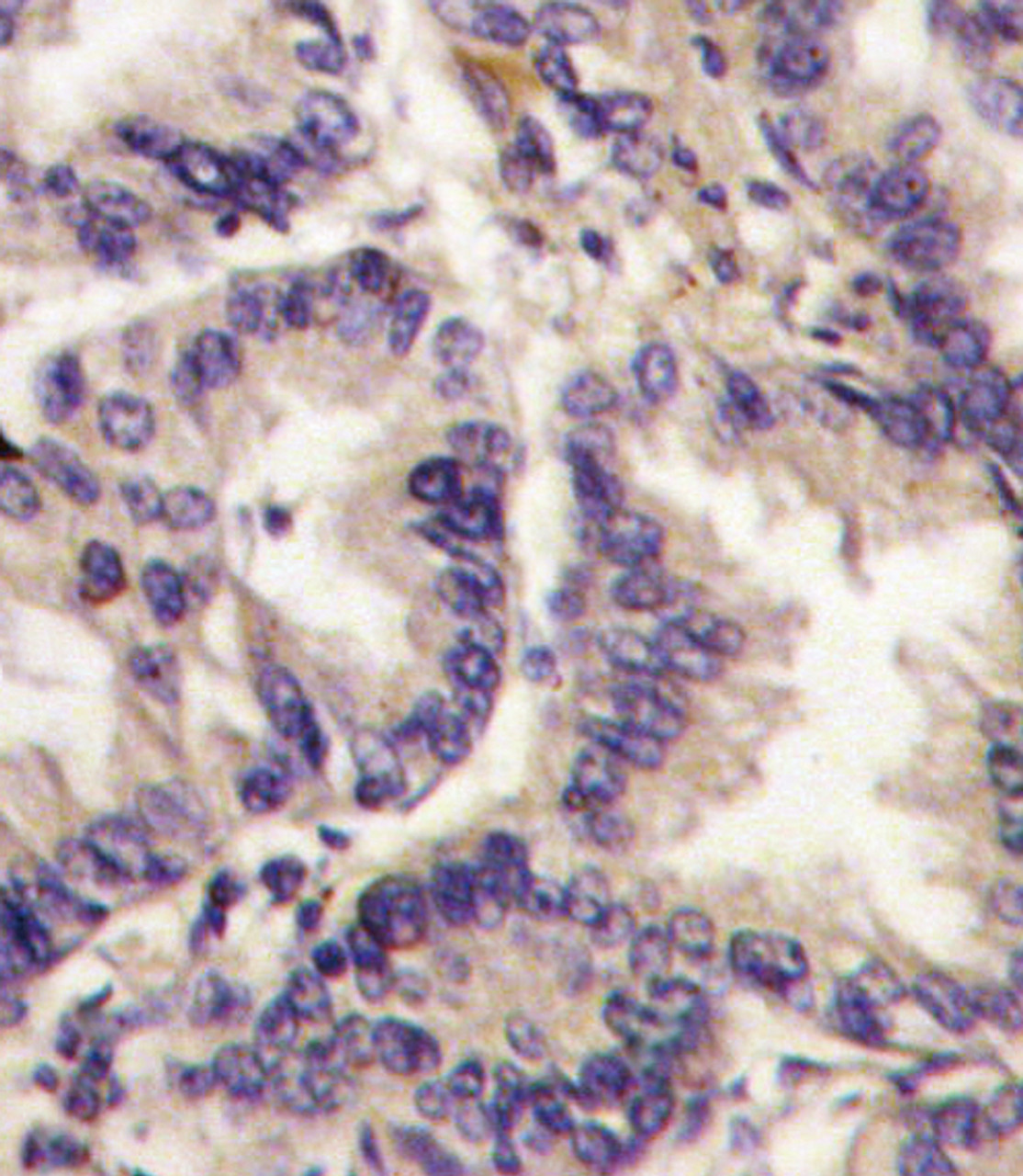 Formalin-fixed and paraffin-embedded human lung carcinoma tissue reacted with, which was peroxidase-conjugated to the secondary antibody, followed by DAB staining.
