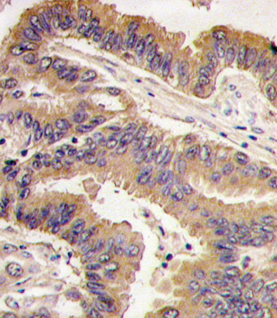 Formalin-fixed and paraffin-embedded human lung carcinoma tissue reacted with GDF5 antibody (N-term) , which was peroxidase-conjugated to the secondary antibody, followed by DAB staining.