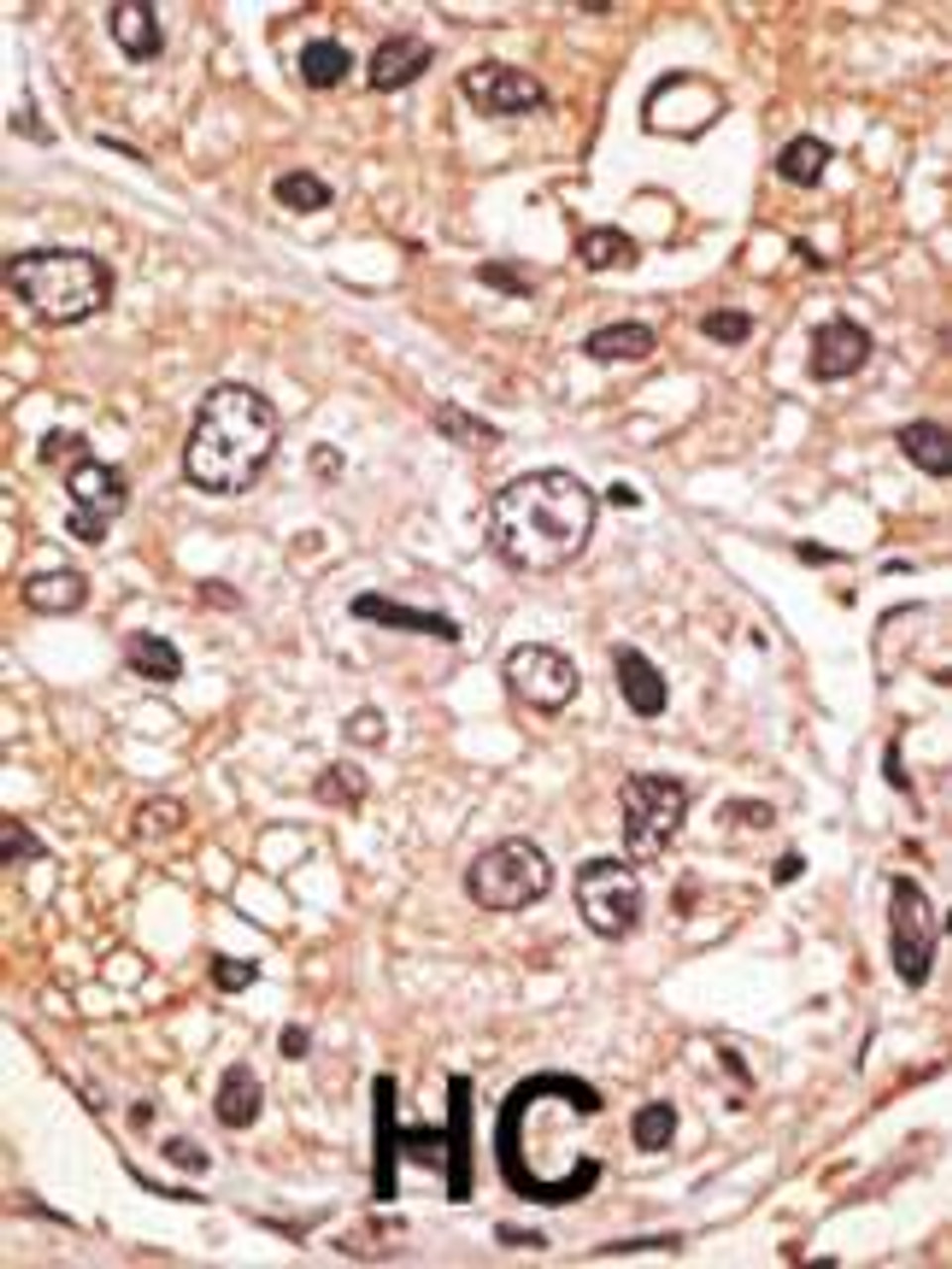 Formalin-fixed and paraffin-embedded human cancer tissue reacted with the primary antibody, which was peroxidase-conjugated to the secondary antibody, followed by AEC staining. BC = breast carcinoma; HC = hepatocarcinoma.