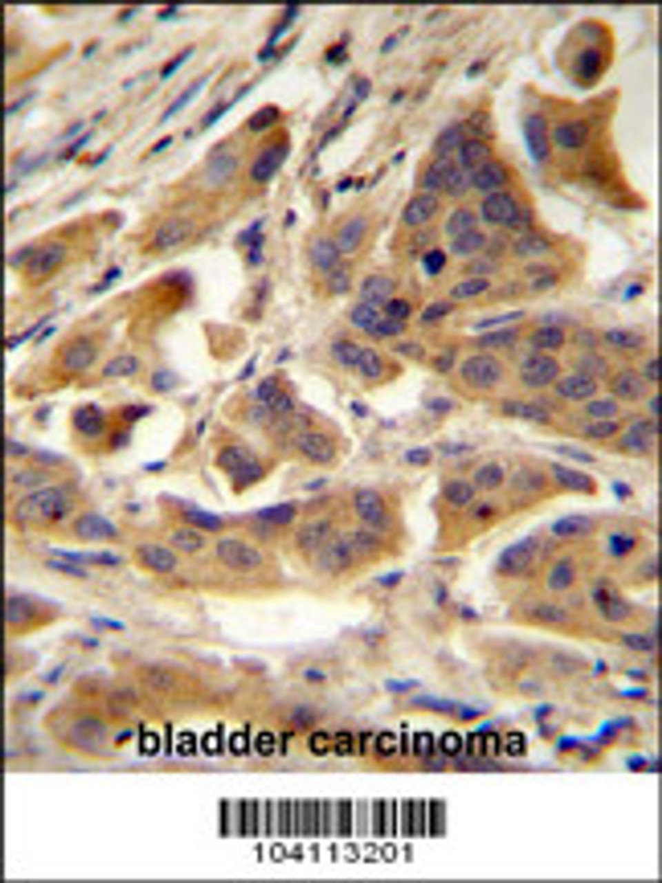 RBCK1 (UBCE7IP3) Antibody immunohistochemistry analysis in formalin fixed and paraffin embedded human bladder carcinoma followed by peroxidase conjugation of the secondary antibody and DAB staining.This data demonstrates the use of RBCK1 (UBCE7IP3) Antibody for immunohistochemistry.