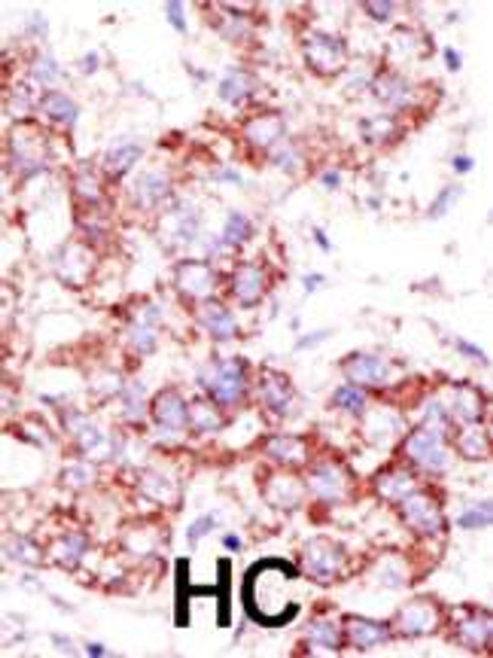 Formalin-fixed and paraffin-embedded human cancer tissue reacted with the primary antibody, which was peroxidase-conjugated to the secondary antibody, followed by AEC staining. BC = breast carcinoma; HC = hepatocarcinoma.