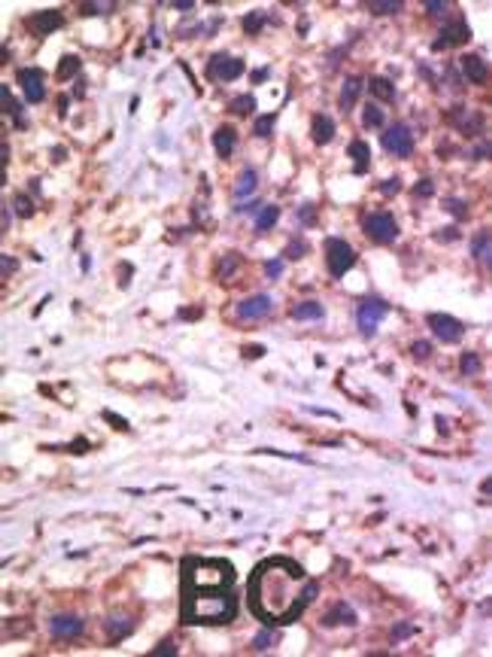 Formalin-fixed and paraffin-embedded human cancer tissue reacted with the primary antibody, which was peroxidase-conjugated to the secondary antibody, followed by AEC staining. BC = breast carcinoma; HC = hepatocarcinoma.