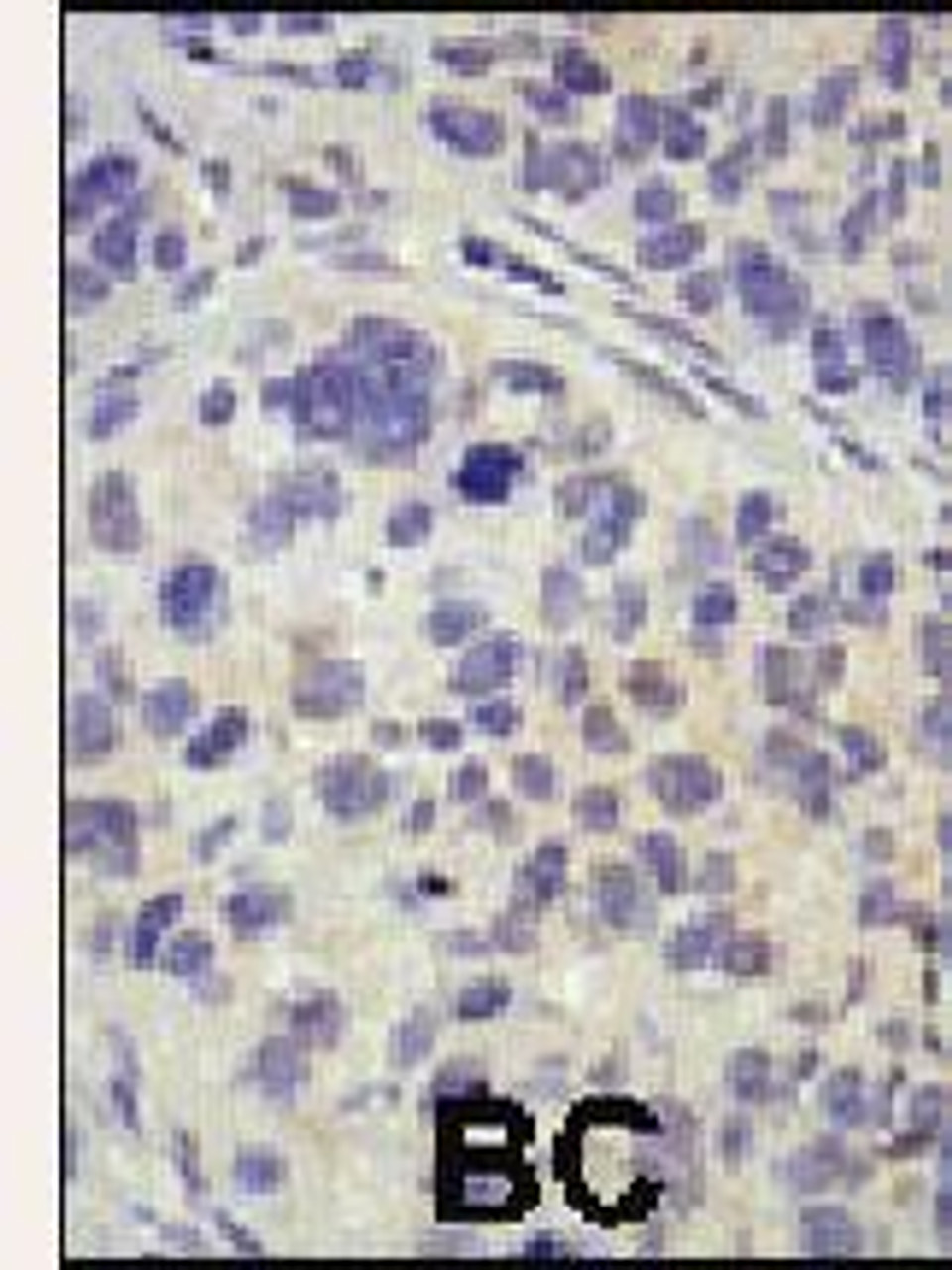 Formalin-fixed and paraffin-embedded human cancer tissue reacted with the primary antibody, which was peroxidase-conjugated to the secondary antibody, followed by AEC staining. BC = breast carcinoma; HC = hepatocarcinoma.