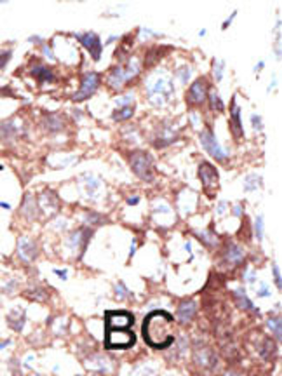 Formalin-fixed and paraffin-embedded human cancer tissue reacted with the primary antibody, which was peroxidase-conjugated to the secondary antibody, followed by DAB staining. BC = breast carcinoma; HC = hepatocarcinoma.