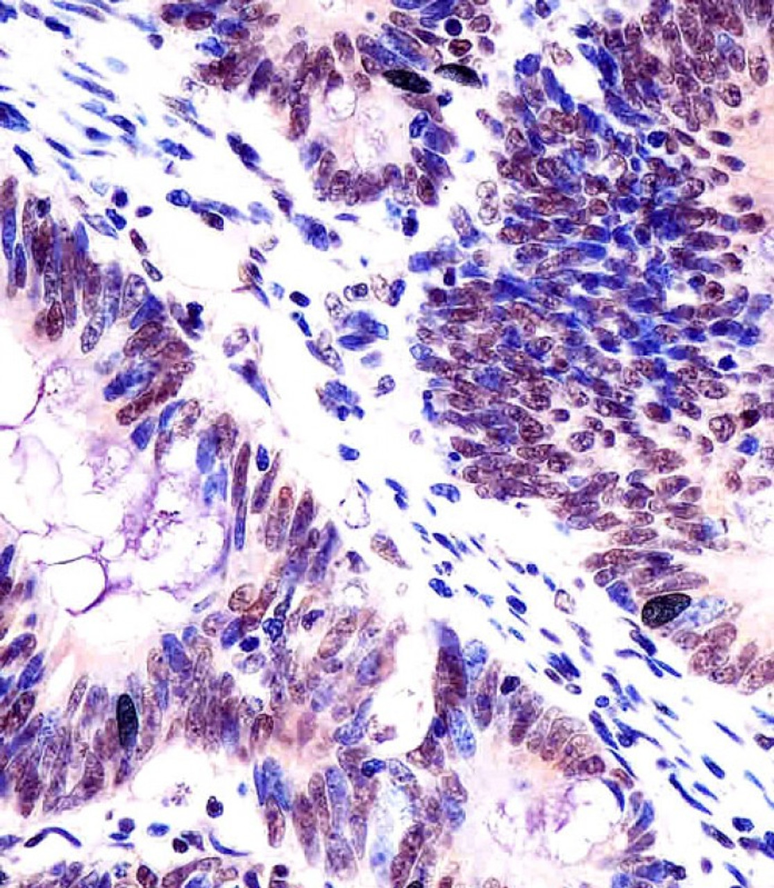 Antibody staining KHDRBS1 in human colorectal carcinoma tissue sections by Immunohistochemistry (IHC-P - paraformaldehyde-fixed, paraffin-embedded sections) .