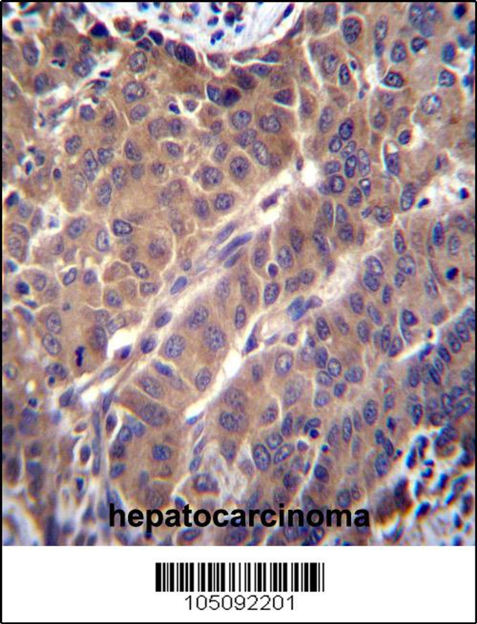 ARL2 Antibody immunohistochemistry analysis in formalin fixed and paraffin embedded human hepatocarcinoma followed by peroxidase conjugation of the secondary antibody and DAB staining.