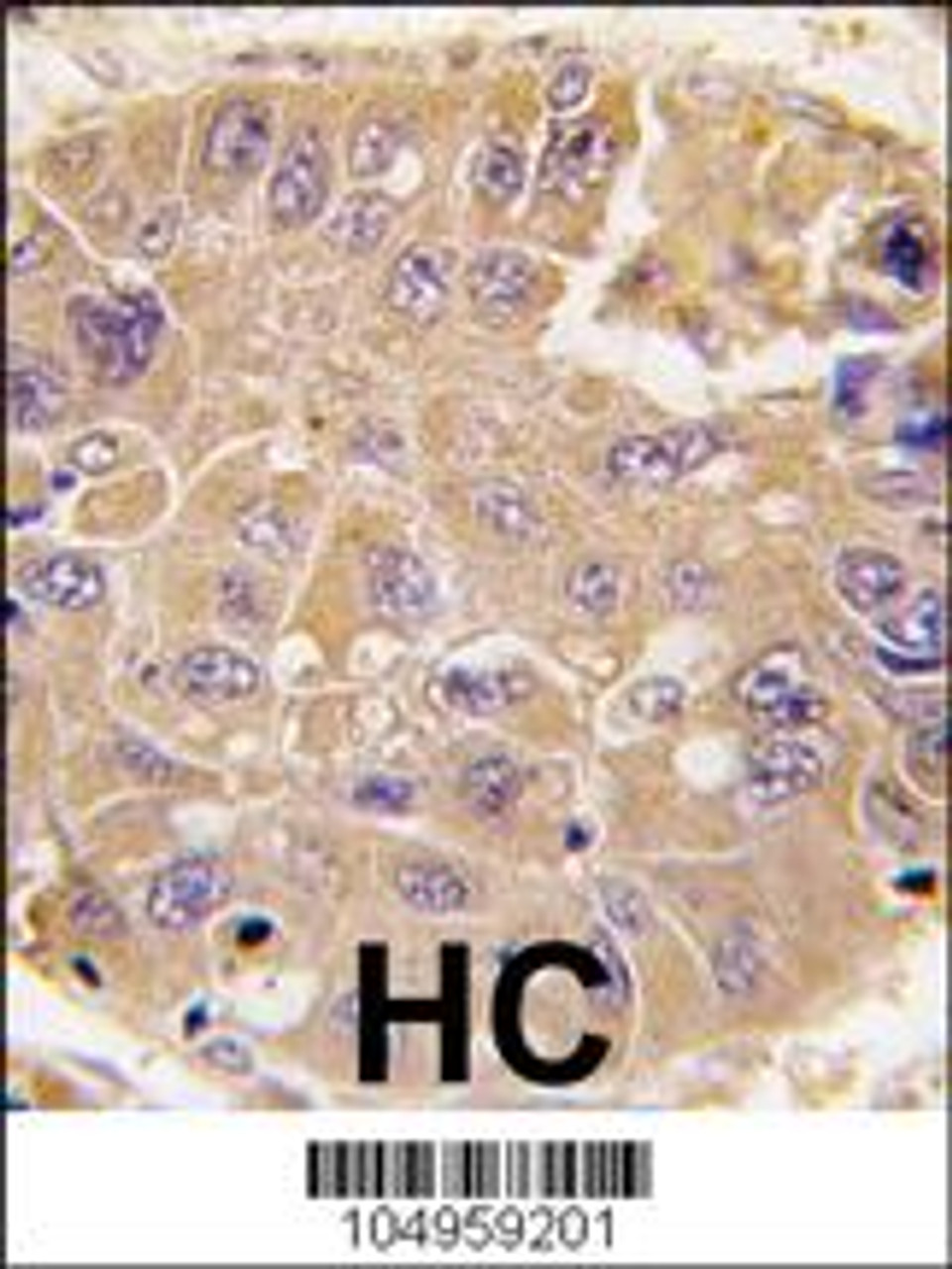 Formalin-fixed and paraffin-embedded human hepatocarcinoma tissue reacted with METAP2 antibody, which was peroxidase-conjugated to the secondary antibody, followed by DAB staining.