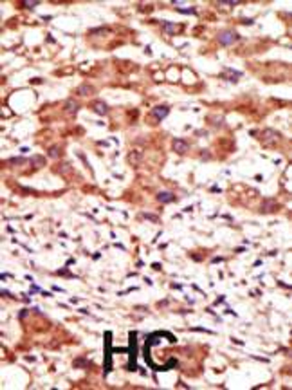 Formalin-fixed and paraffin-embedded human cancer tissue reacted with the primary antibody, which was peroxidase-conjugated to the secondary antibody, followed by AEC staining. BC = breast carcinoma; HC = hepatocarcinoma.