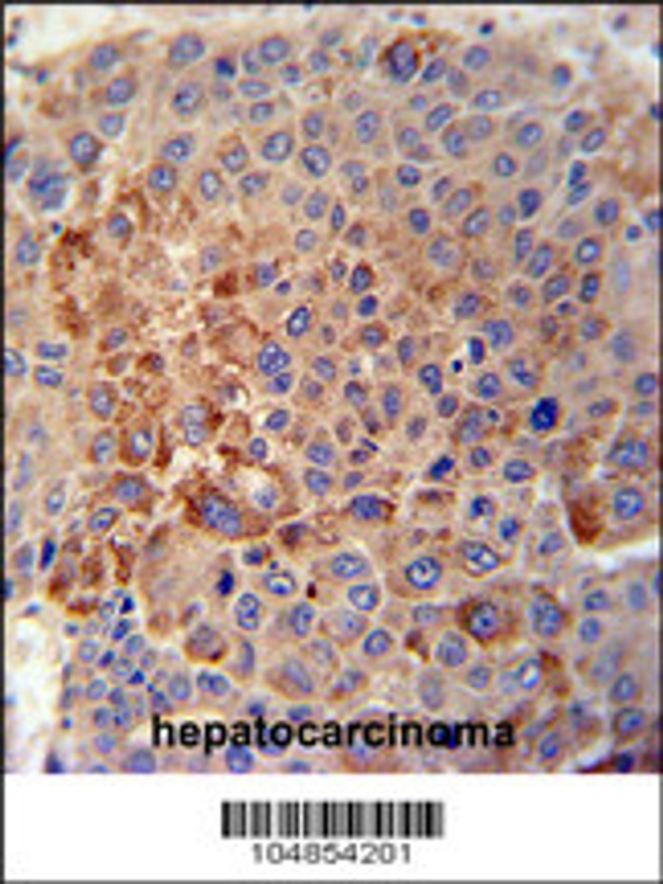 GPLD1 Antibody immunohistochemistry analysis in formalin fixed and paraffin embedded human hepatocarcinoma tissue followed by peroxidase conjugation of the secondary antibody and DAB staining.