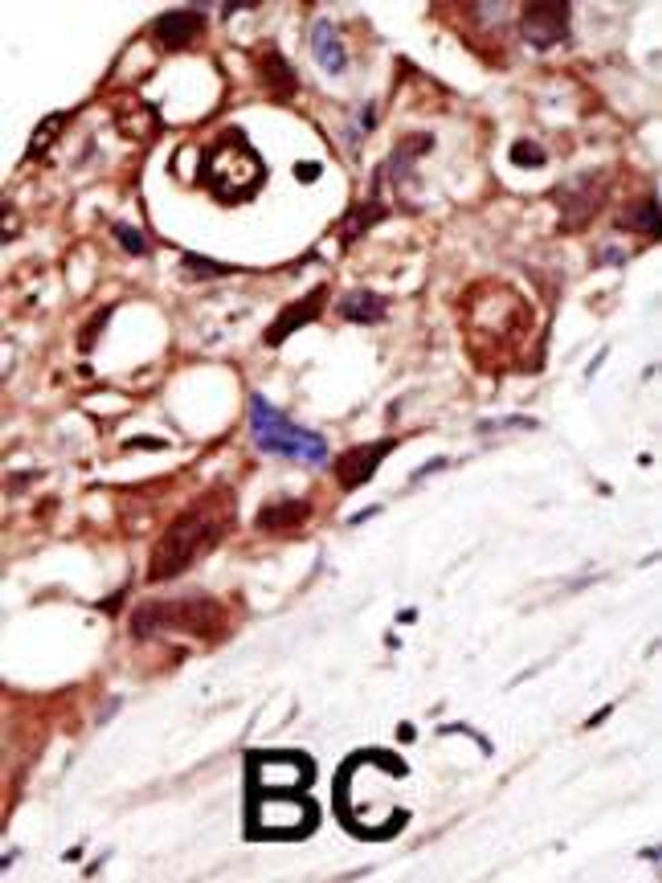 Formalin-fixed and paraffin-embedded human cancer tissue reacted with the primary antibody, which was peroxidase-conjugated to the secondary antibody, followed by DAB staining. BC = breast carcinoma; HC = hepatocarcinoma.