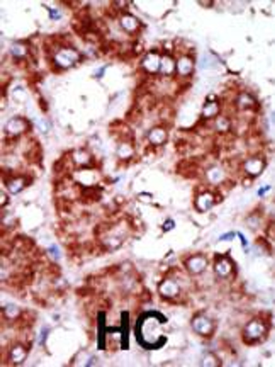 Formalin-fixed and paraffin-embedded human cancer tissue reacted with the primary antibody, which was peroxidase-conjugated to the secondary antibody, followed by DAB staining. BC = breast carcinoma; HC = hepatocarcinoma.