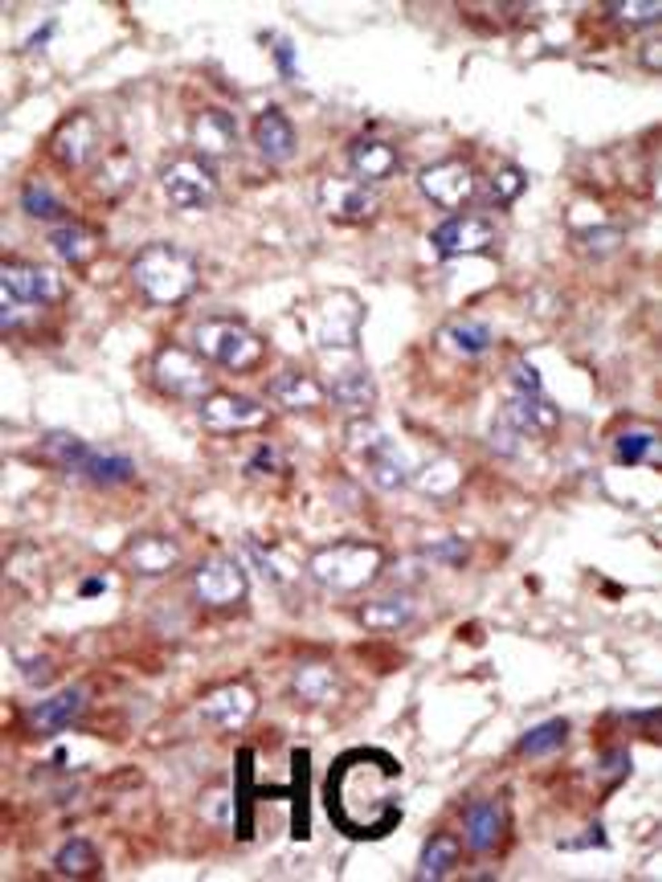 Formalin-fixed and paraffin-embedded human cancer tissue reacted with the primary antibody, which was peroxidase-conjugated to the secondary antibody, followed by AEC staining. BC = breast carcinoma; HC = hepatocarcinoma.