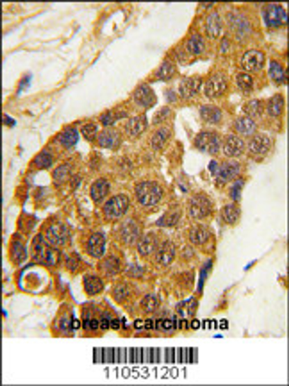 Formalin-fixed and paraffin-embedded human breast carcinoma tissue reacted with Msx2 Antibody, which was peroxidase-conjugated to the secondary antibody, followed by DAB staining.
