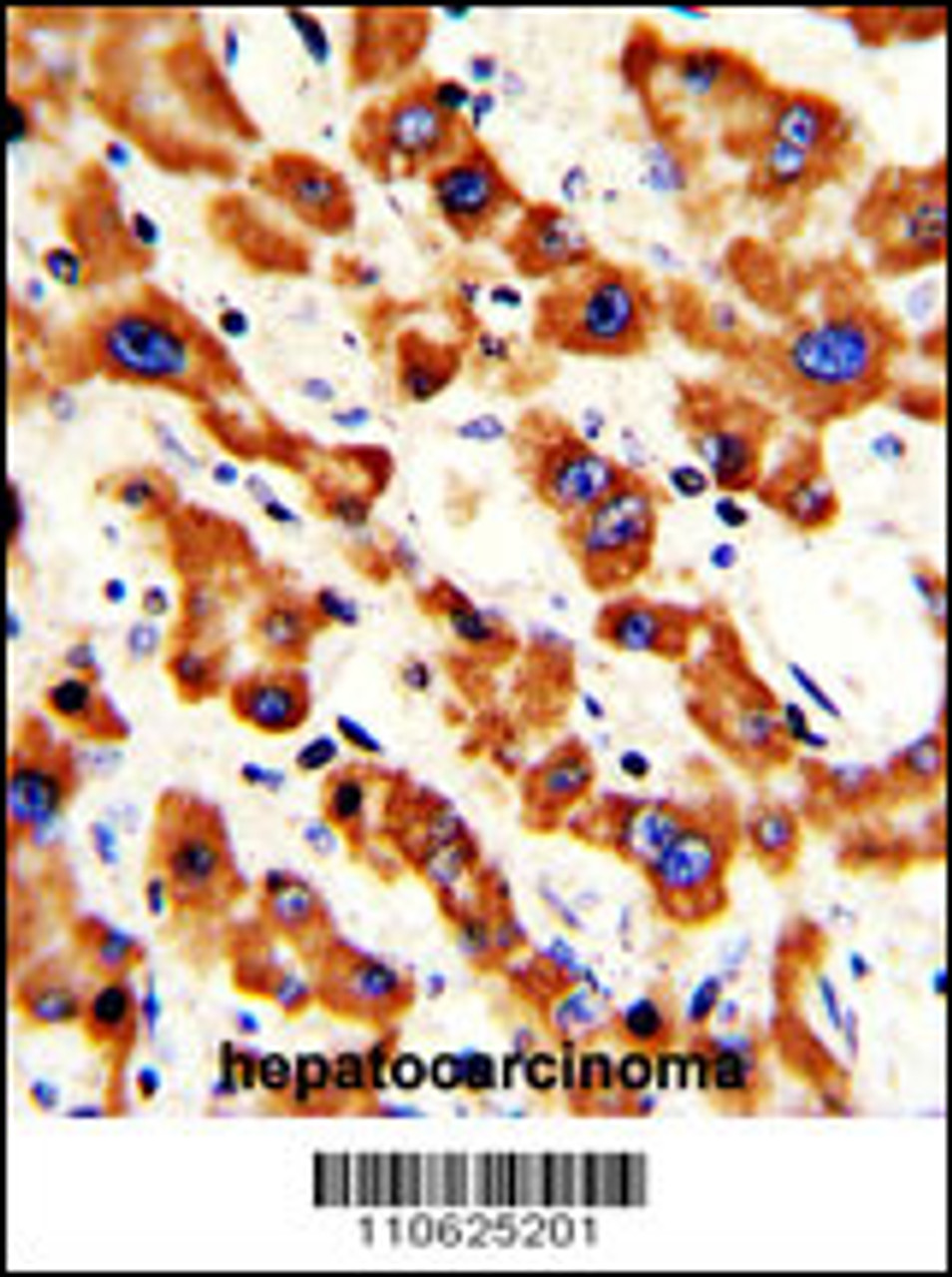 Formalin-fixed and paraffin-embedded human hepatocarcinoma with Prohibitin (PHB1) Antibody (N-term) , which was peroxidase-conjugated to the secondary antibody, followed by DAB staining.