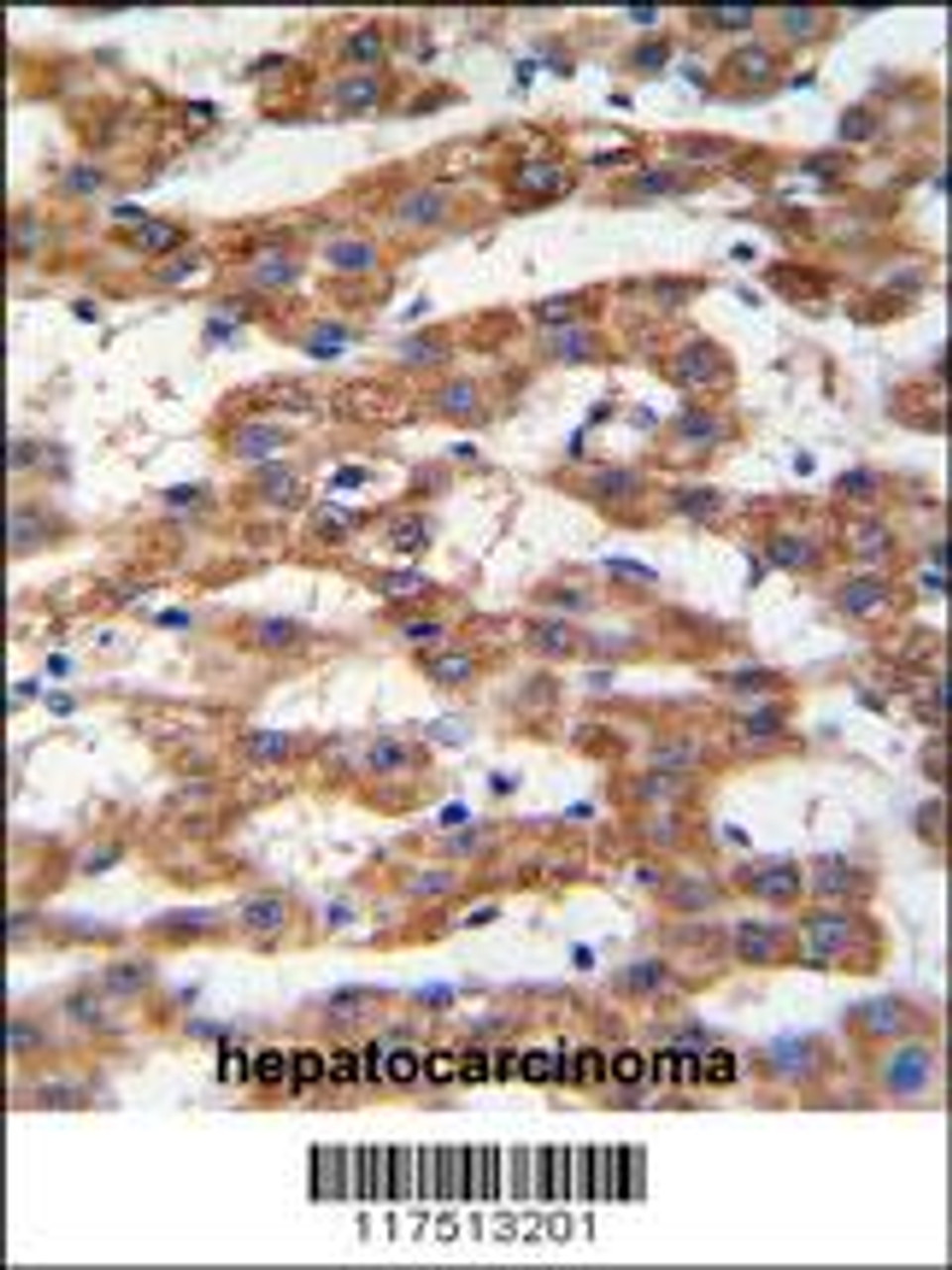 Formalin-fixed and paraffin-embedded human hepatocarcinoma tissue reacted with PHB antibody, which was peroxidase-conjugated to the secondary antibody, followed by DAB staining.