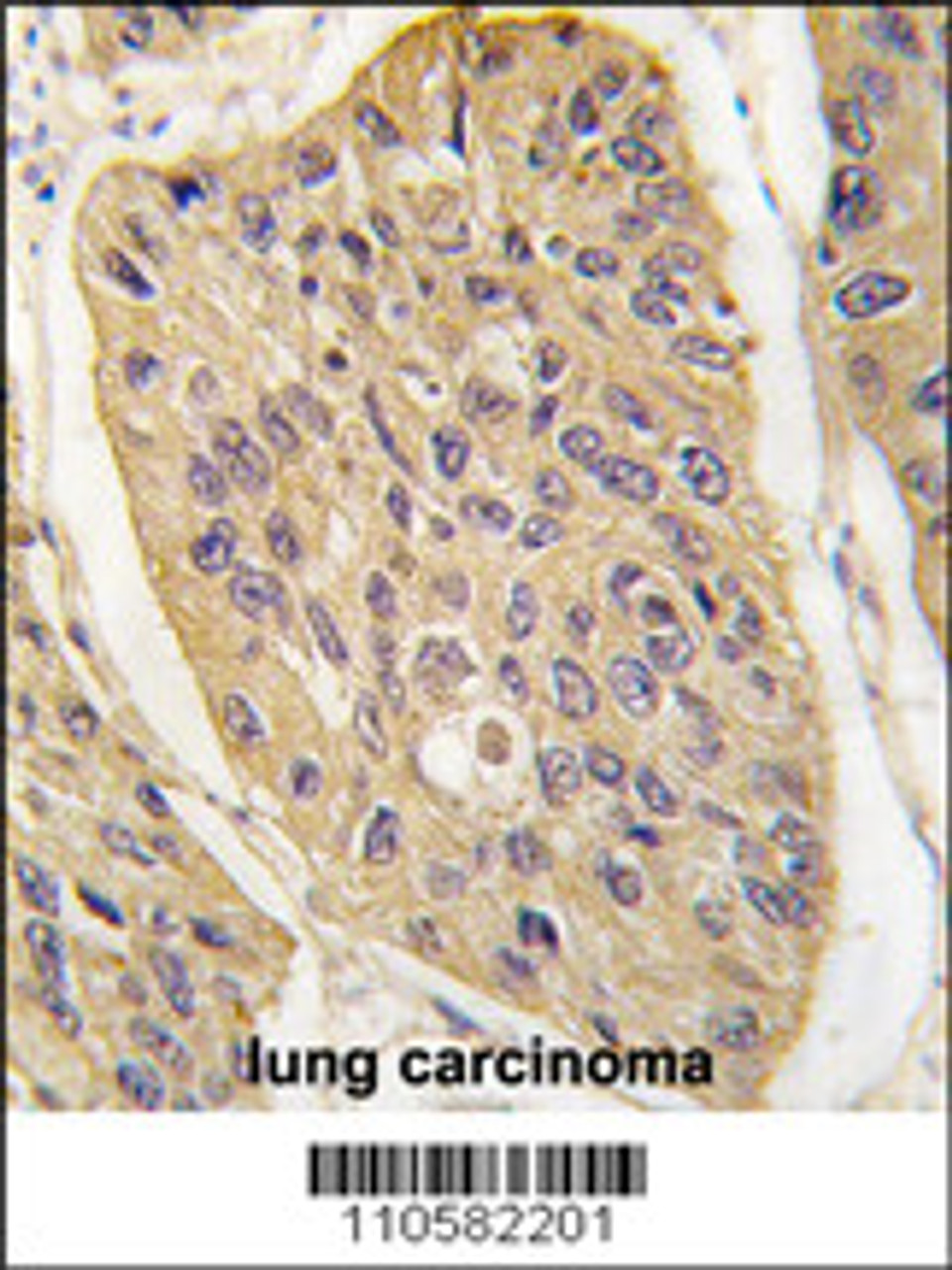 Formalin-fixed and paraffin-embedded human lung carcinoma tissue reacted with WIF1 (Human C-term) , which was peroxidase-conjugated to the secondary antibody, followed by DAB staining.