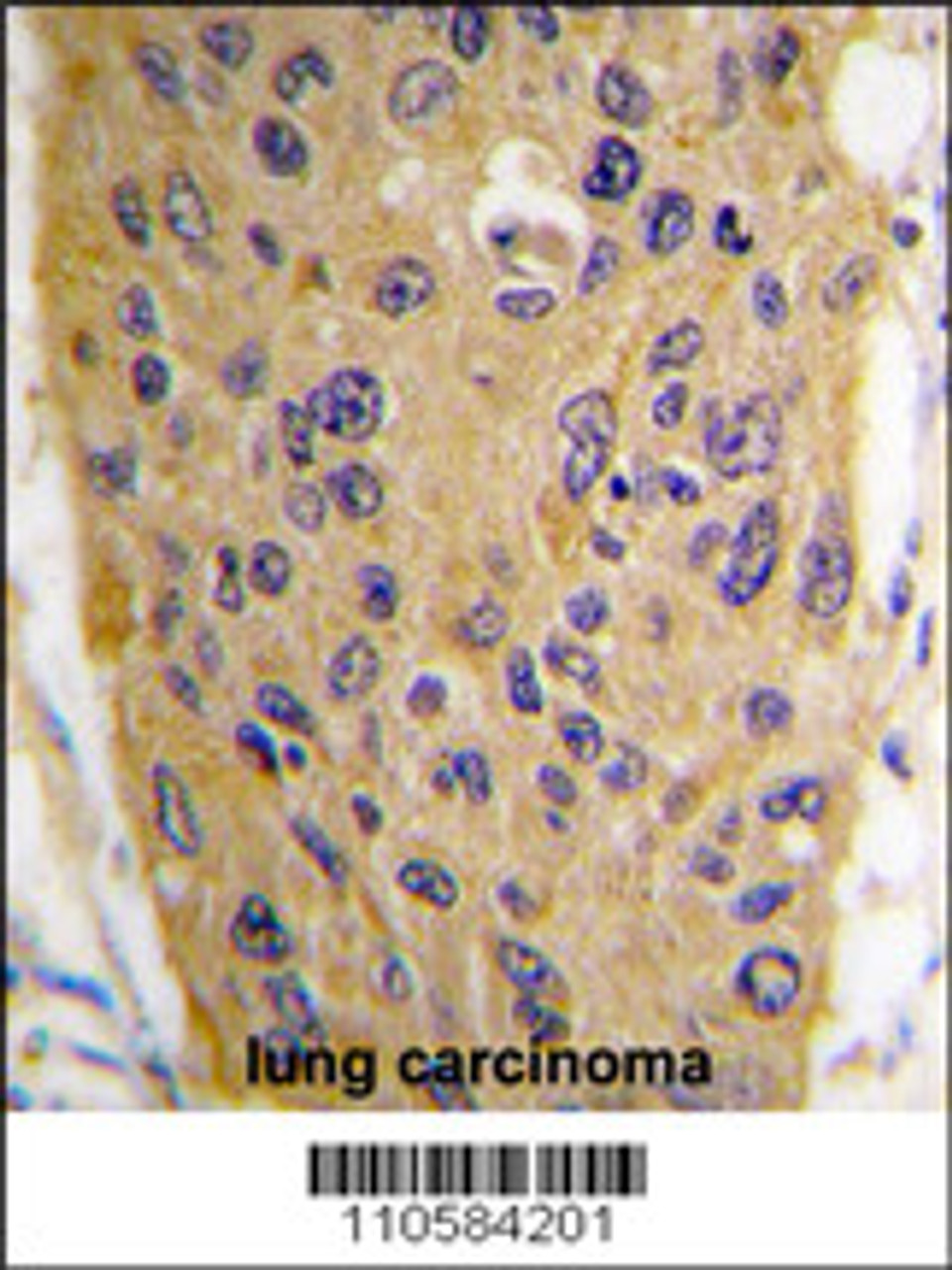 Formalin-fixed and paraffin-embedded human lung carcinoma tissue reacted with WIF1 Antibody, which was peroxidase-conjugated to the secondary antibody, followed by DAB staining.