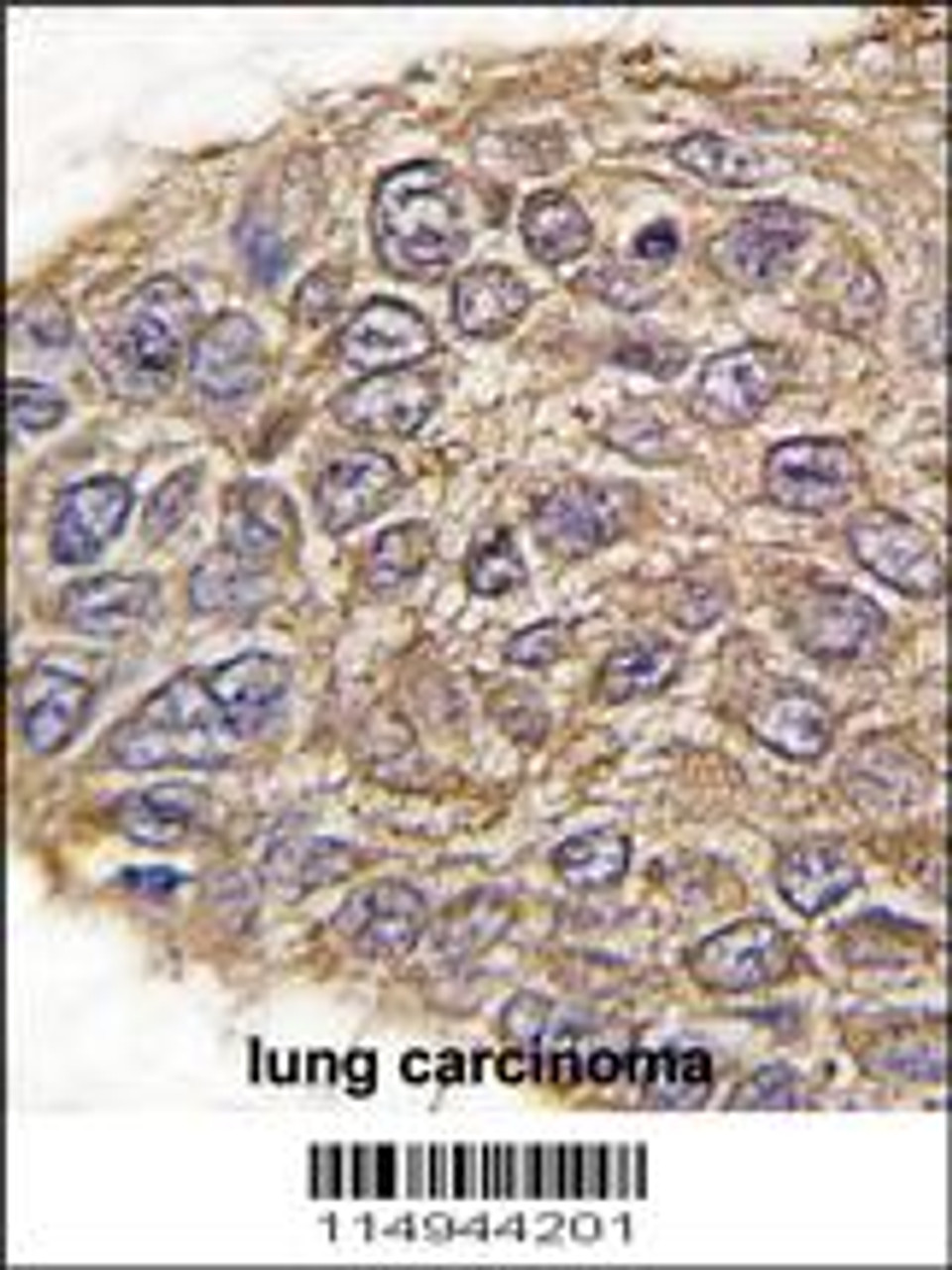 Formalin-fixed and paraffin-embedded human lung carcinoma tissue reacted with ALDOA antibody, which was peroxidase-conjugated to the secondary antibody, followed by DAB staining.