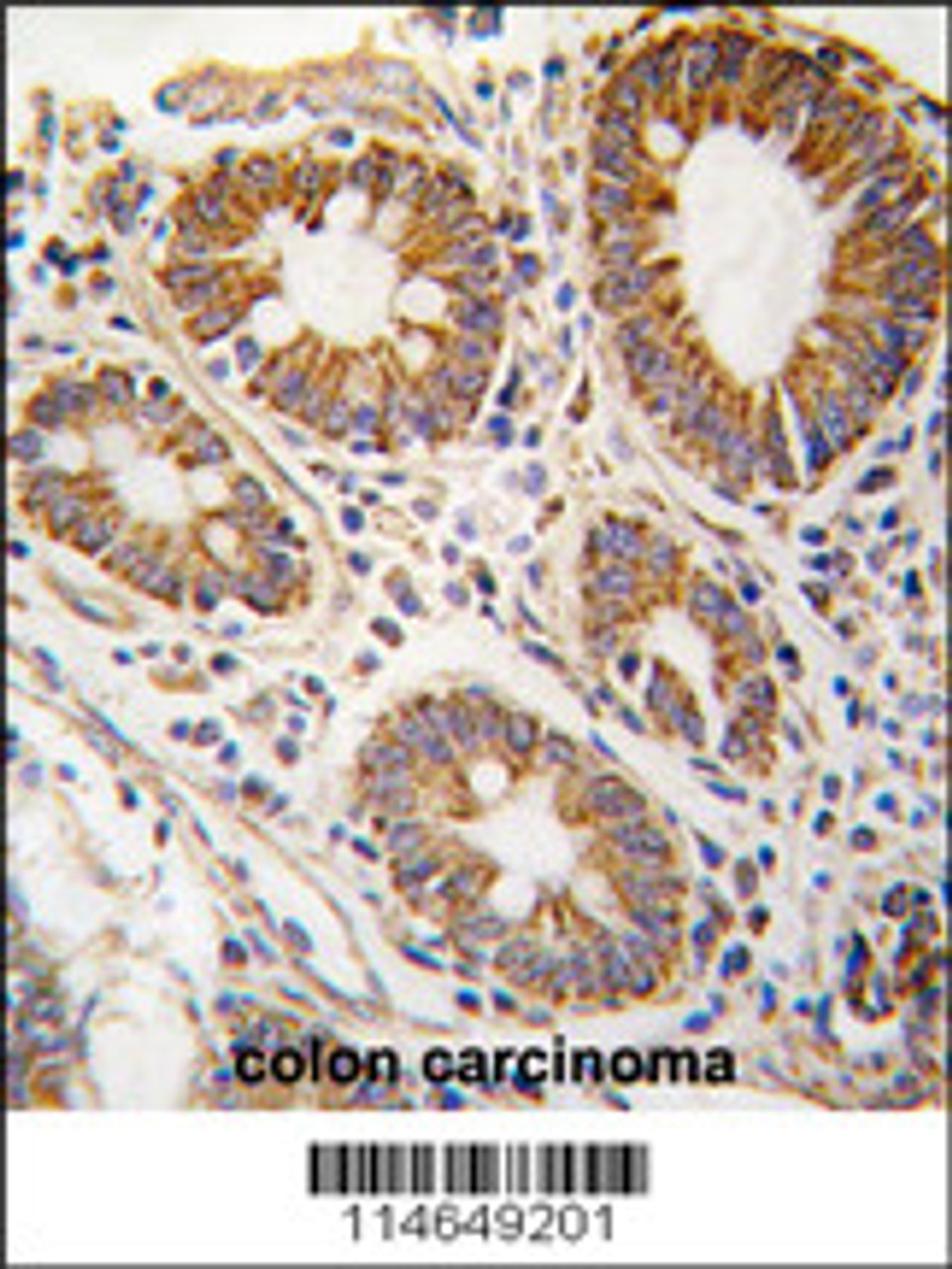 Formalin-fixed and paraffin-embedded human hepatocarcinoma tissue reacted with AHCY antibody, which was peroxidase-conjugated to the secondary antibody, followed by DAB staining.