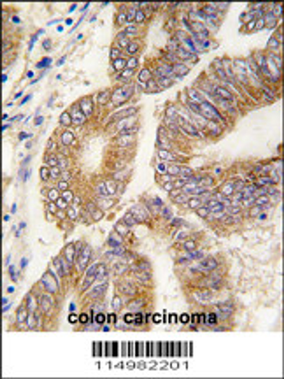 Formalin-fixed and paraffin-embedded human colon carcinoma tissue reacted with AHCY antibody, which was peroxidase-conjugated to the secondary antibody, followed by DAB staining.