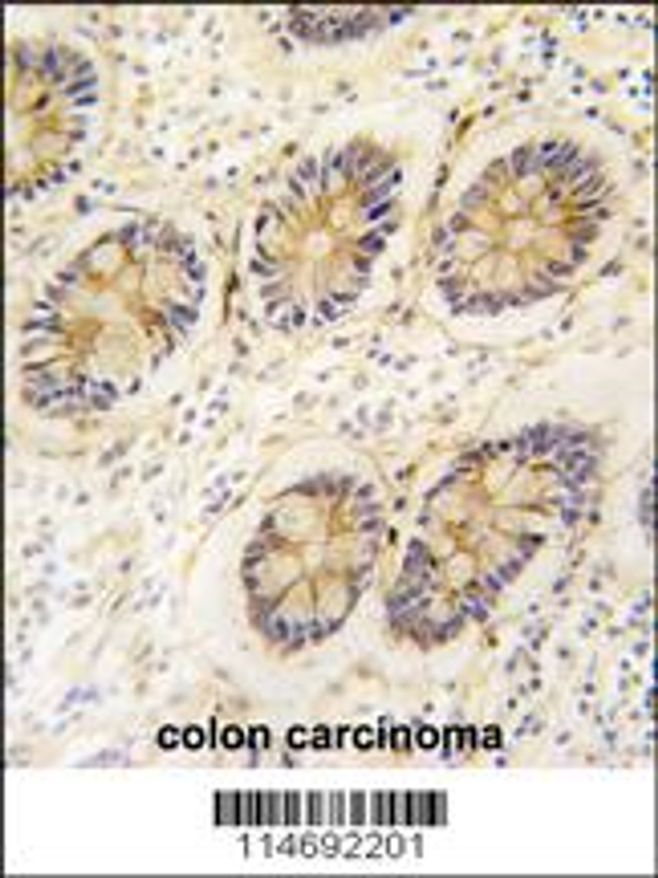 Formalin-fixed and paraffin-embedded human colon carcinoma tissue reacted with AKR1B1 antibody, which was peroxidase-conjugated to the secondary antibody, followed by DAB staining.