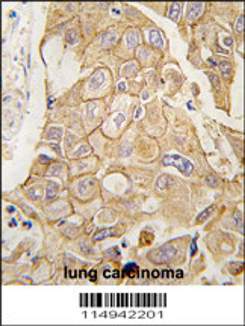 Formalin-fixed and paraffin-embedded human lung carcinoma tissue reacted with ADCY2 antibody, which was peroxidase-conjugated to the secondary antibody, followed by DAB staining.