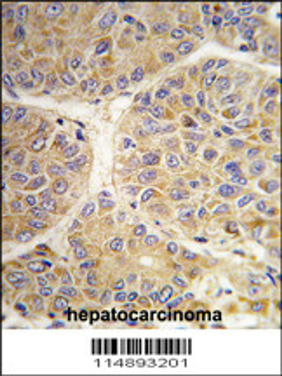 Formalin-fixed and paraffin-embedded human hepatocarcinoma tissue reacted with the AASS antibody, which was peroxidase-conjugated to the secondary antibody, followed by DAB staining.