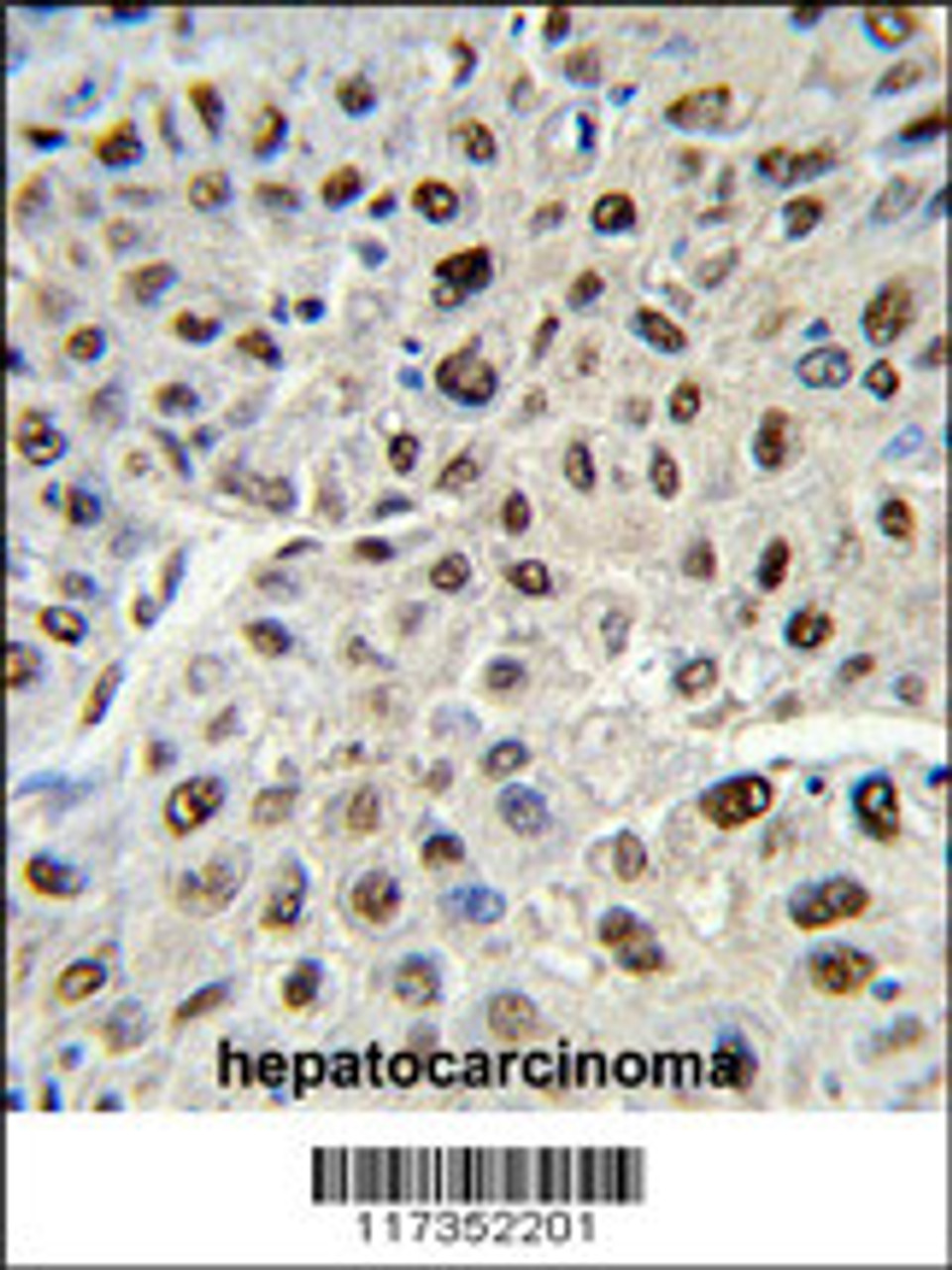 Formalin-fixed and paraffin-embedded human hepatocarcinoma reacted with SSB Antibody, which was peroxidase-conjugated to the secondary antibody, followed by DAB staining.