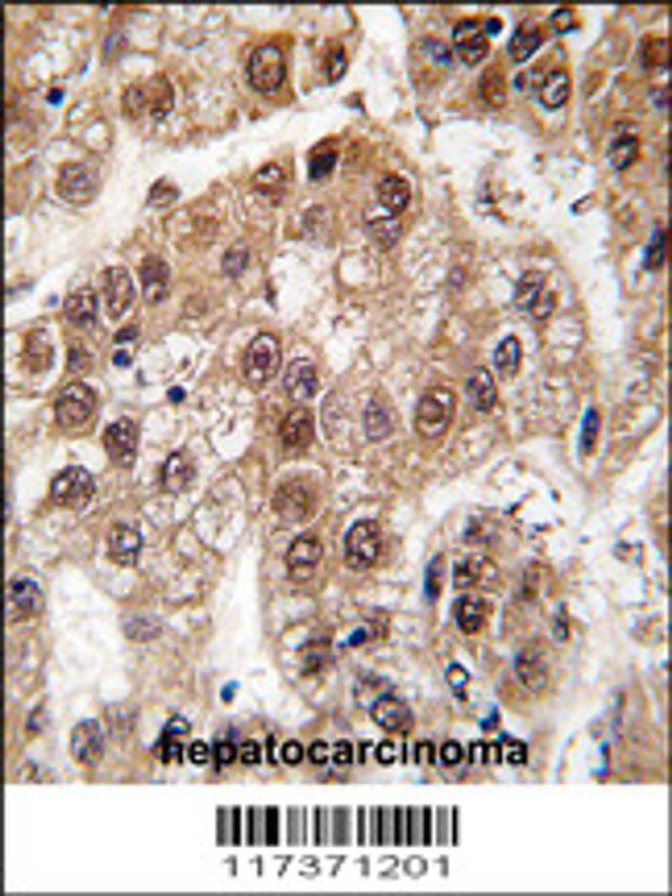 Formalin-fixed and paraffin-embedded human hepatocarcinoma tissue reacted with U2AF1 antibody (Center S70) , which was peroxidase-conjugated to the secondary antibody, followed by DAB staining.