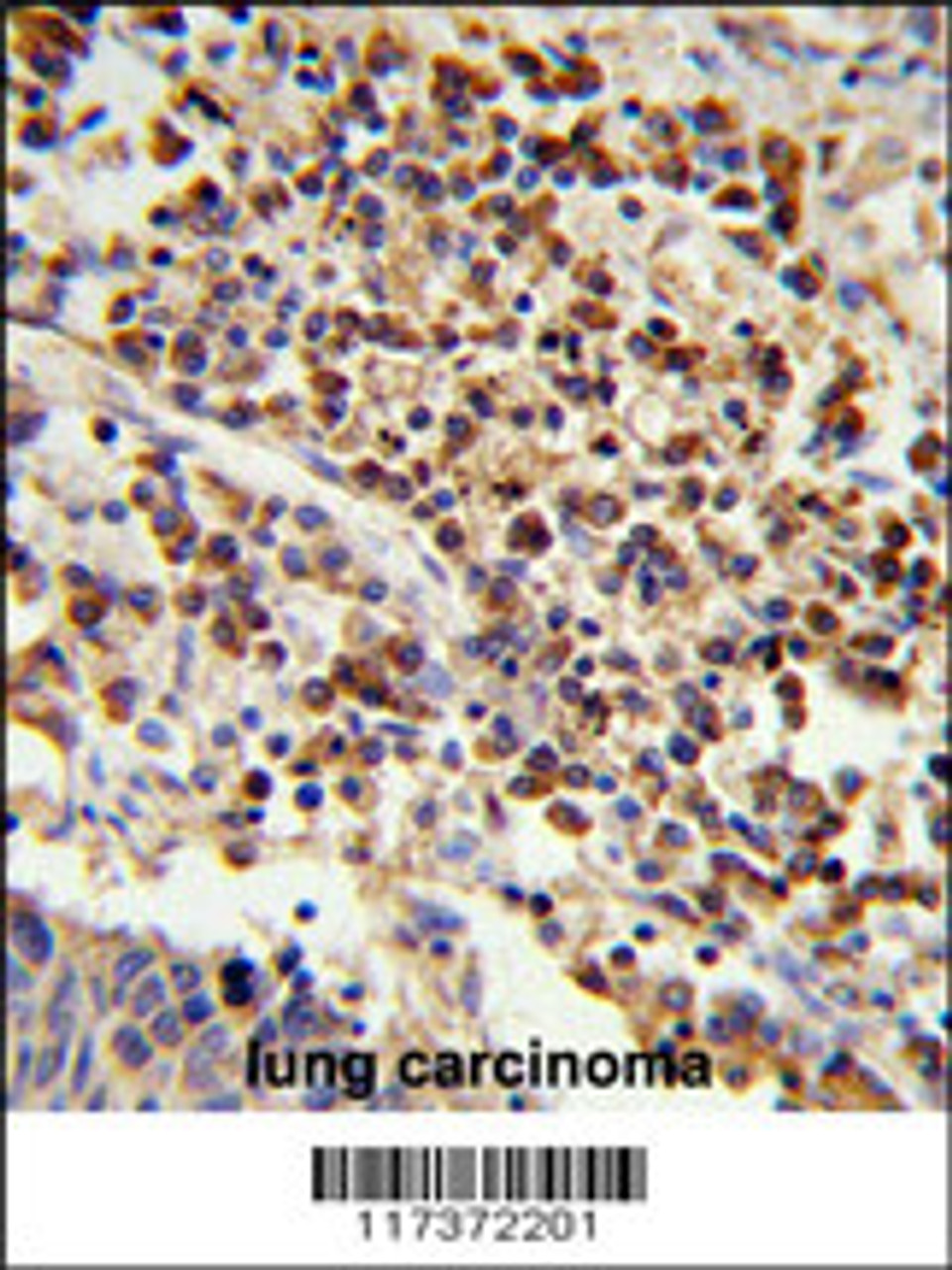 Formalin-fixed and paraffin-embedded human lung carcinoma reacted with, which was peroxidase-conjugated to the secondary antibody, followed by DAB staining.