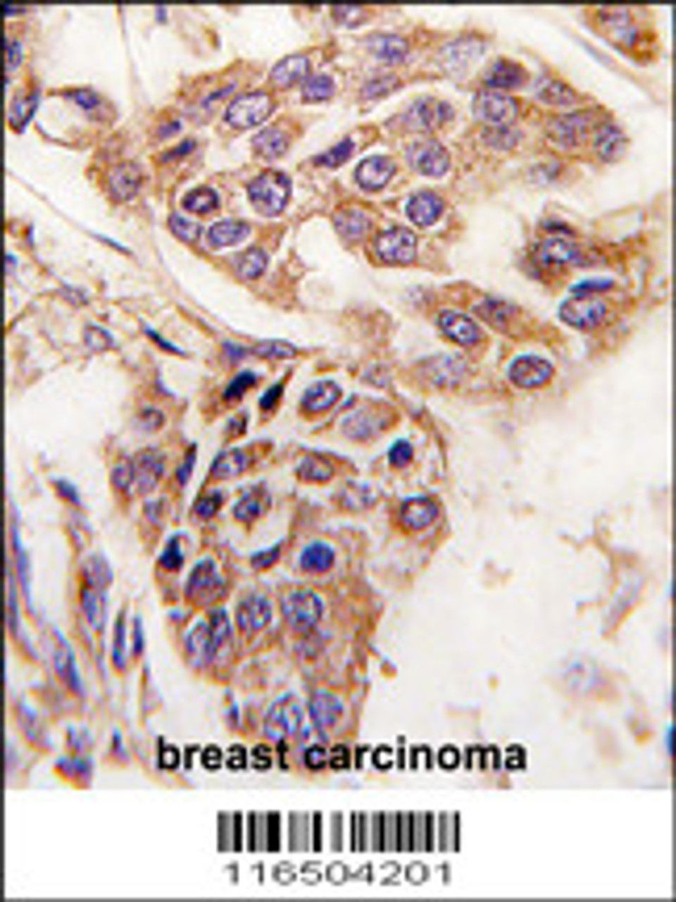 Formalin-fixed and paraffin-embedded human breast carcinoma tissue reacted with C8orf32 antibody, which was peroxidase-conjugated to the secondary antibody, followed by DAB staining.