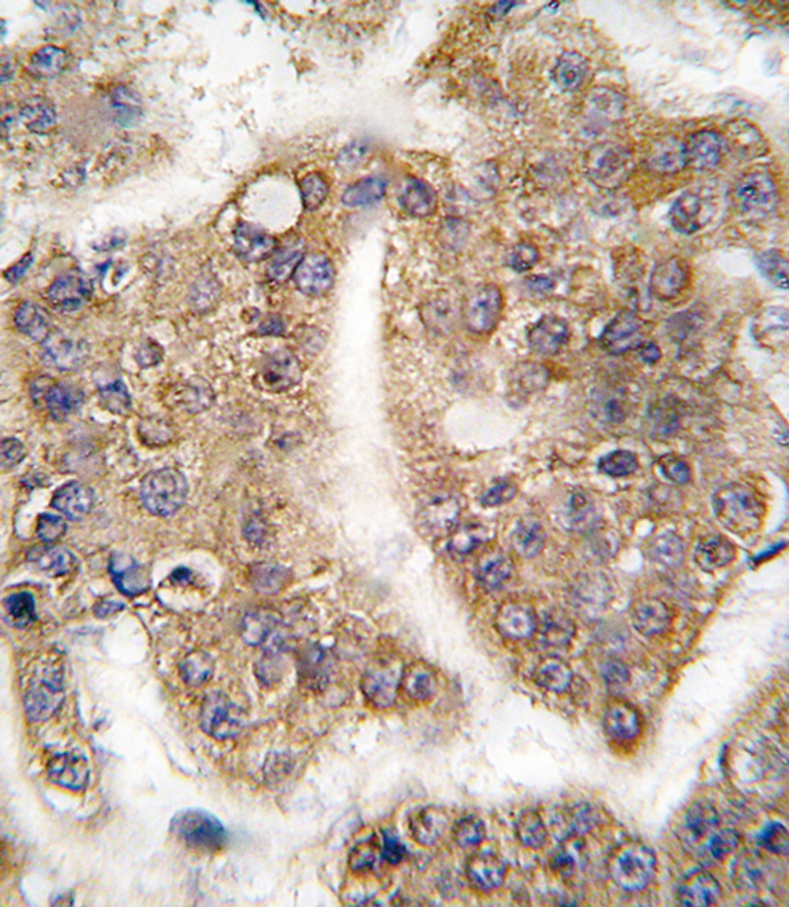 Formalin-fixed and paraffin-embedded human hepatocarcinoma tissue reacted with TRAIP antibody, which was peroxidase-conjugated to the secondary antibody, followed by DAB staining.