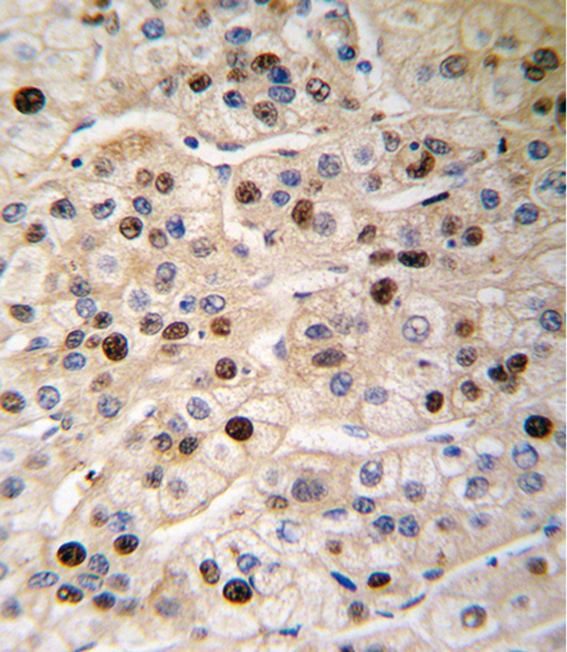 Formalin-fixed and paraffin-embedded human hepatocarcinoma tissue reacted with PCNA antibody, which was peroxidase-conjugated to the secondary antibody, followed by DAB staining.
