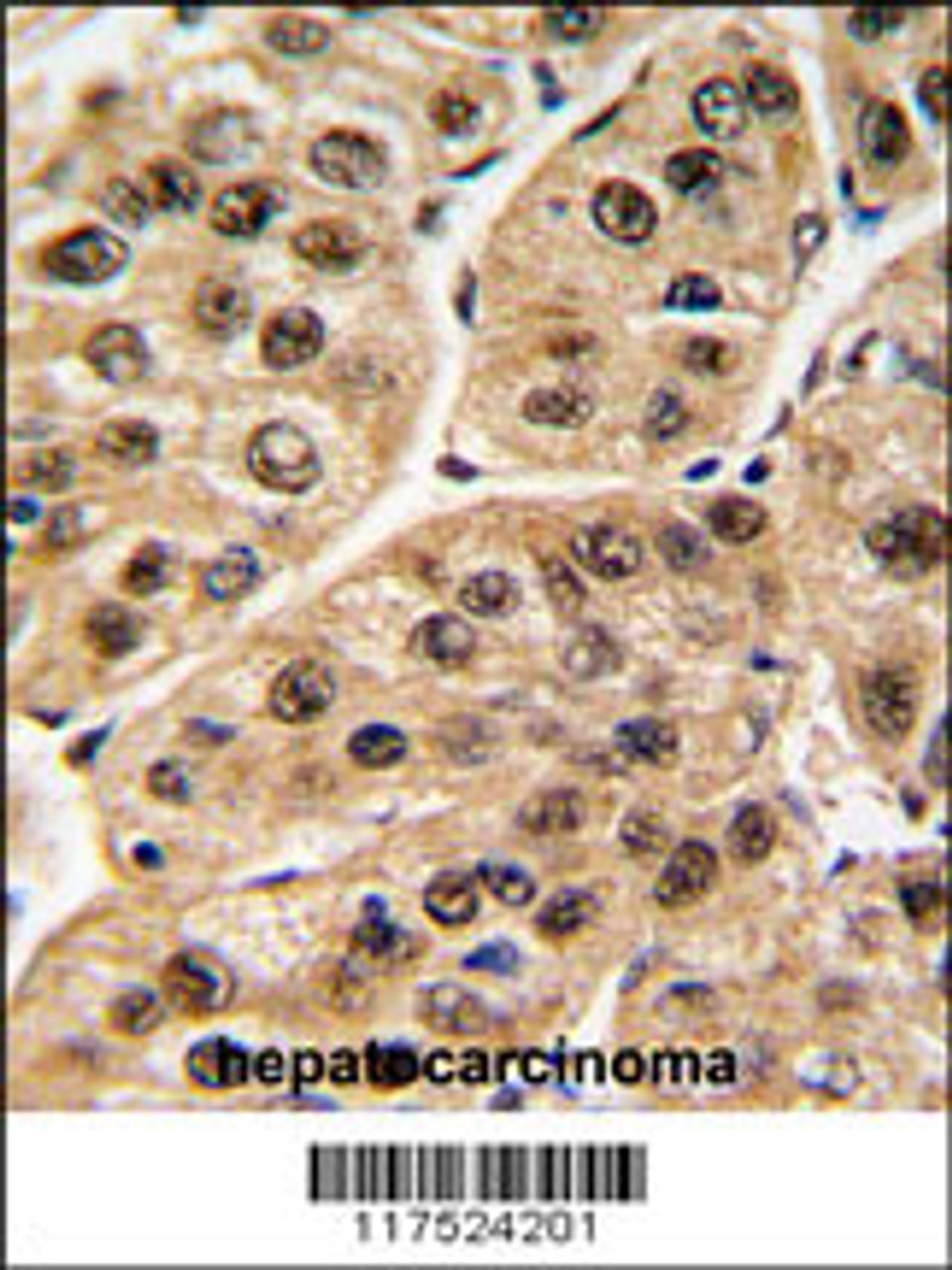 Formalin-fixed and paraffin-embedded human hepatocarcinoma tissue reacted with POLR1C antibody, which was peroxidase-conjugated to the secondary antibody, followed by DAB staining.