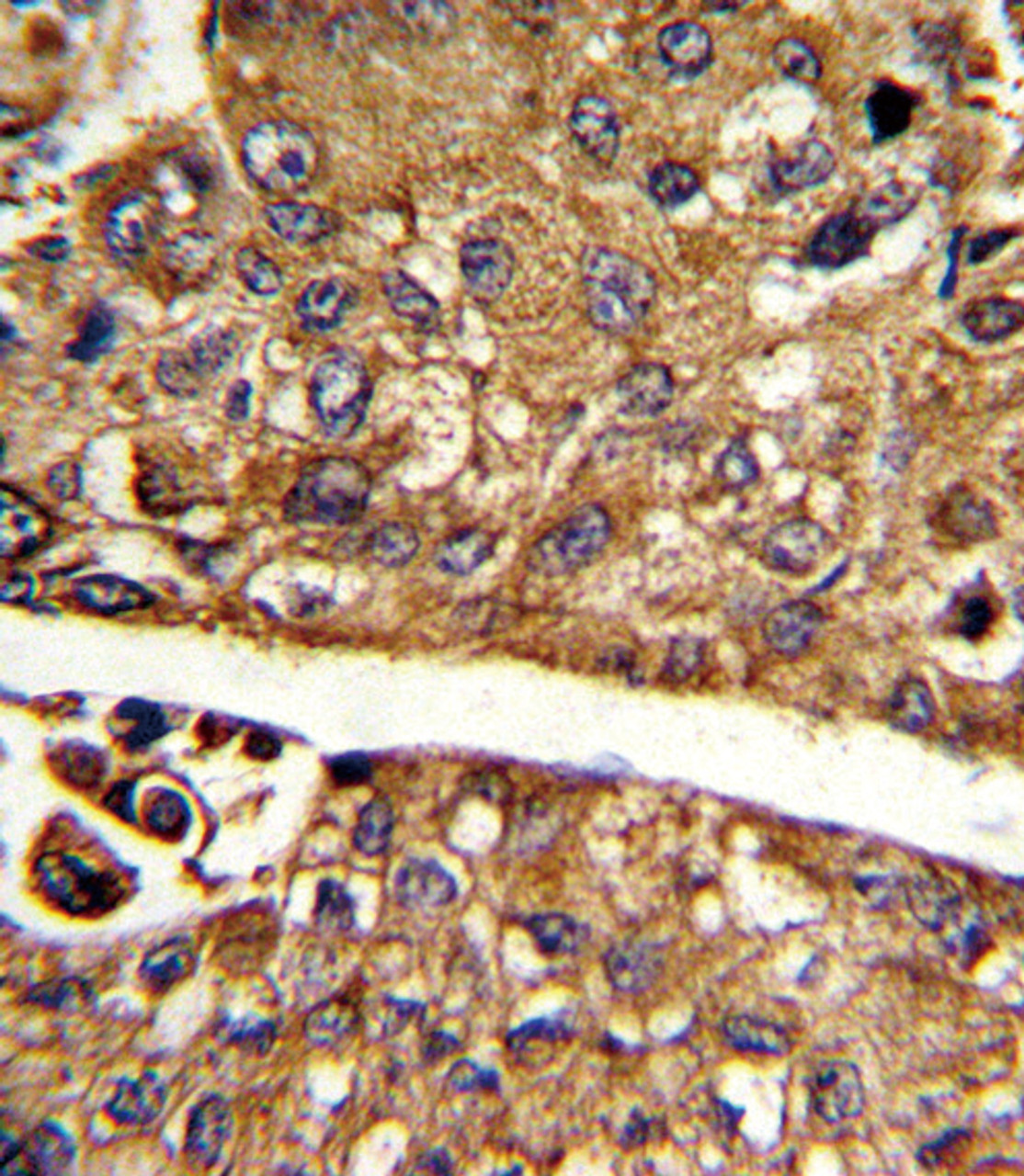 Formalin-fixed and paraffin-embedded human hepatocarcinoma reacted with MDH1 Antibody, which was peroxidase-conjugated to the secondary antibody, followed by DAB staining.