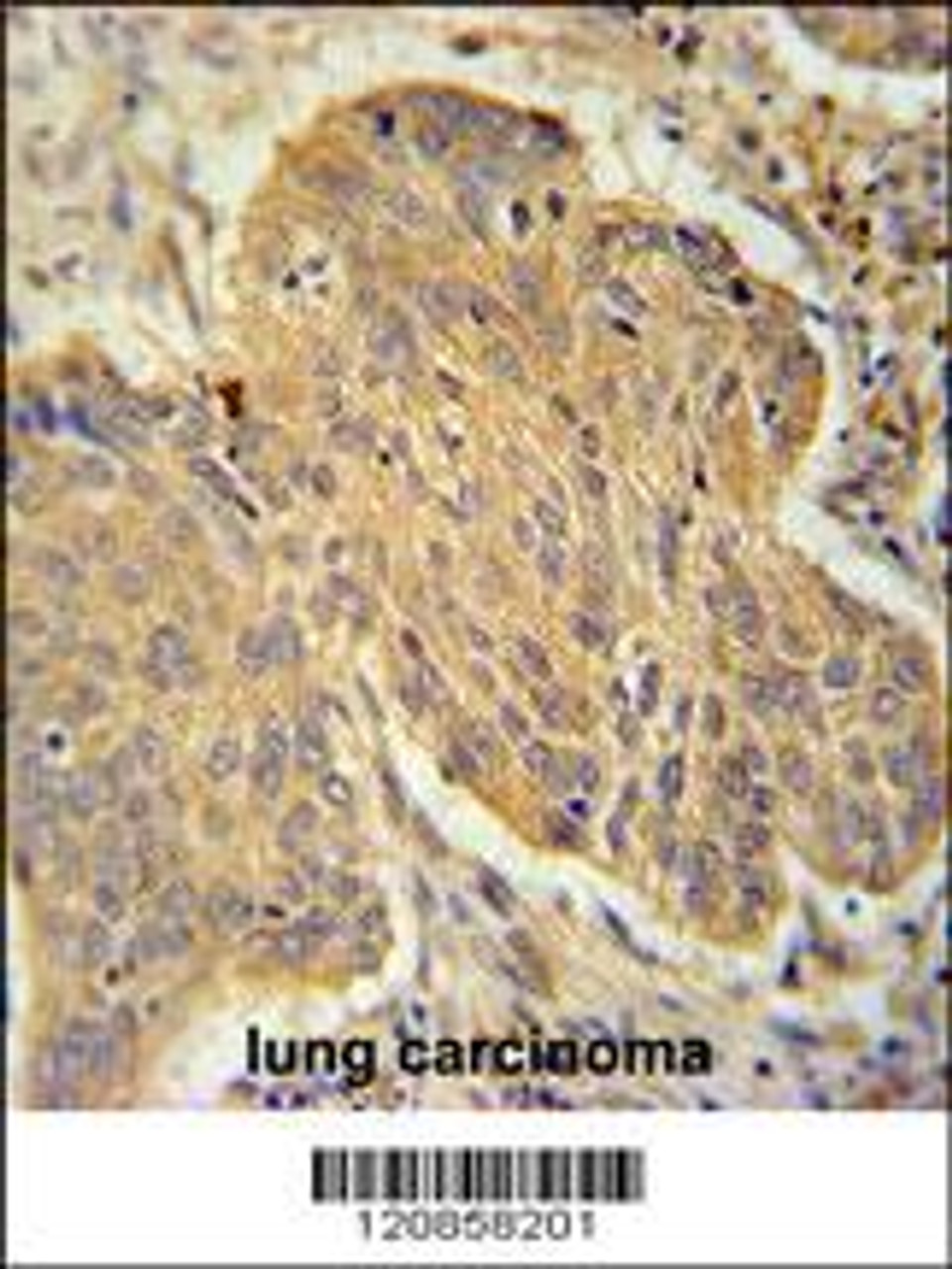 PSMD7 Antibody immunohistochemistry analysis in formalin fixed and paraffin embedded human lung carcinoma followed by peroxidase conjugation of the secondary antibody and DAB staining.